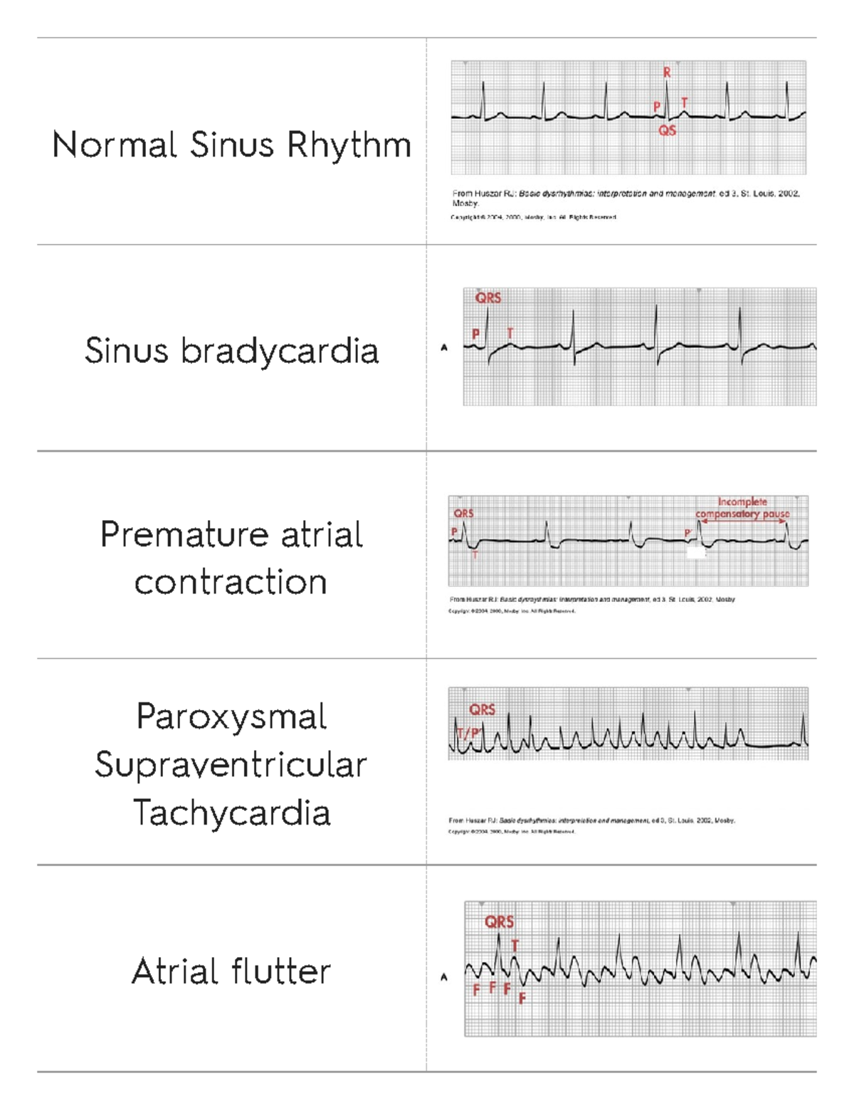 EKG JUST Rhythm Strips nclex - Nursing - Normal Sinus Rhythm Sinus ...