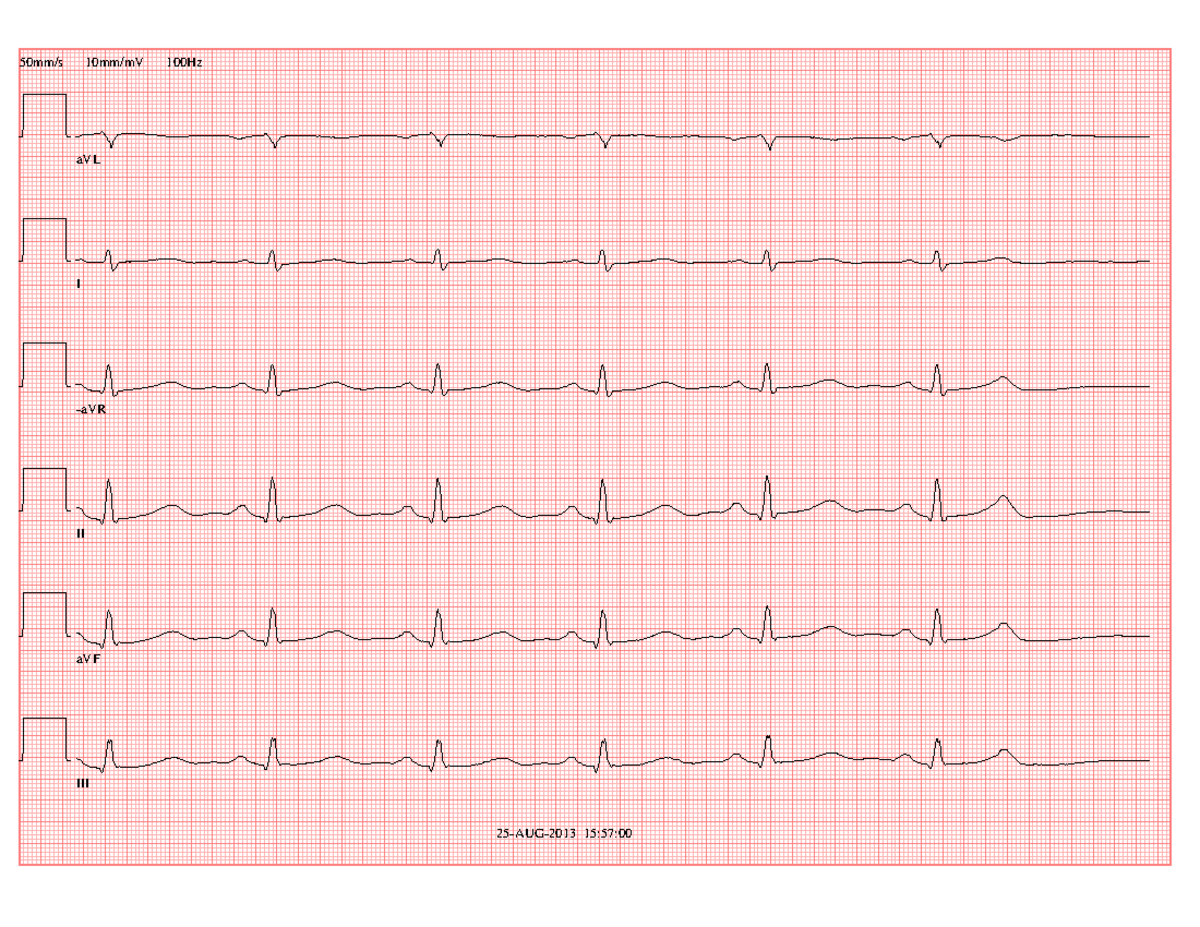 Fall 1, Man 62 år - EKG fall - 3ME074 - aVL I -aVR II aVF III 25-AUG ...