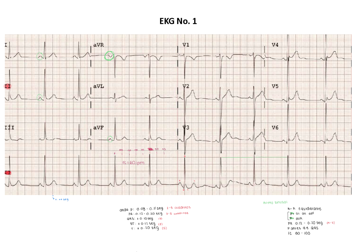 EKG ejemplos - I aVR V1 V4 II aVL V2 V5 III aVF V3 V6 300 180 100 75 60 ...