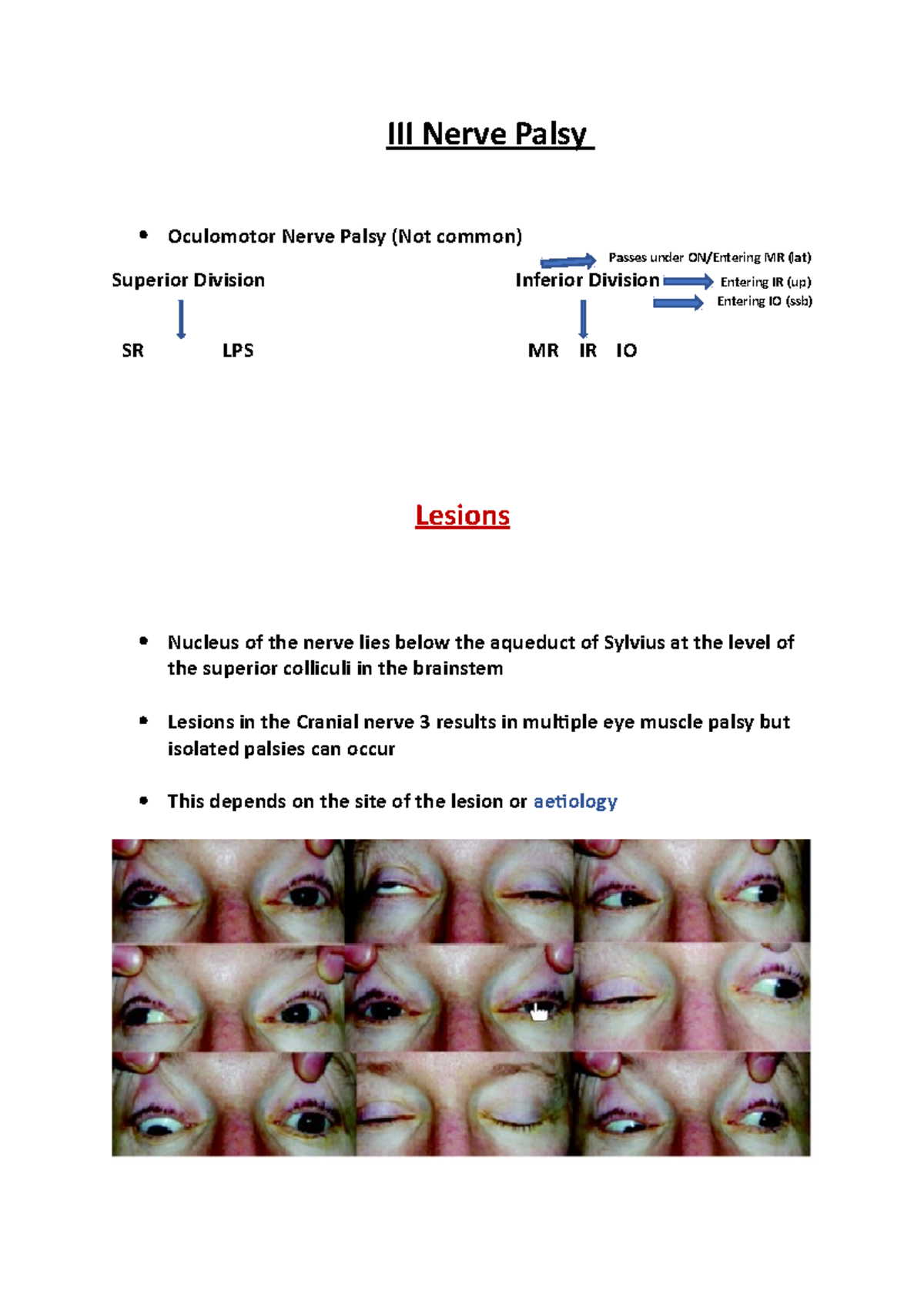 III Nerve Palsy - n/a - III Nerve Palsy Oculomotor Nerve Palsy (Not ...