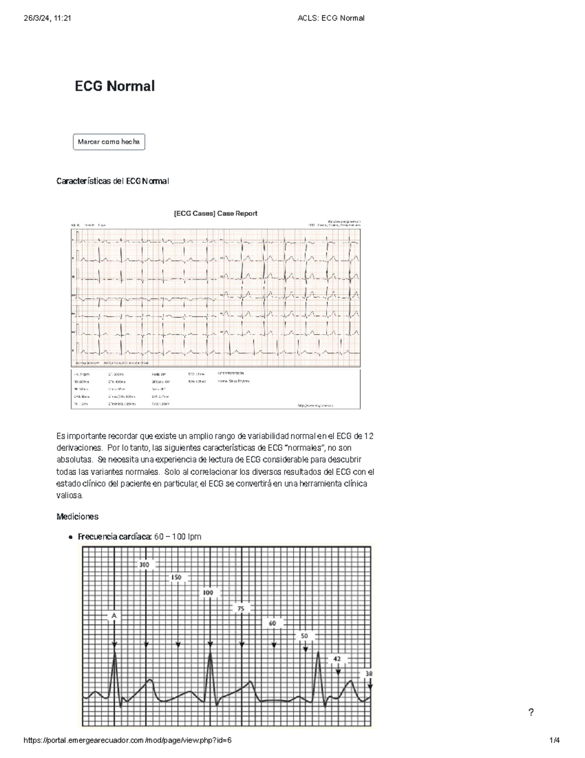 ACLS ECG Normal - Marcar como hecha Características del ECG Normal Es ...