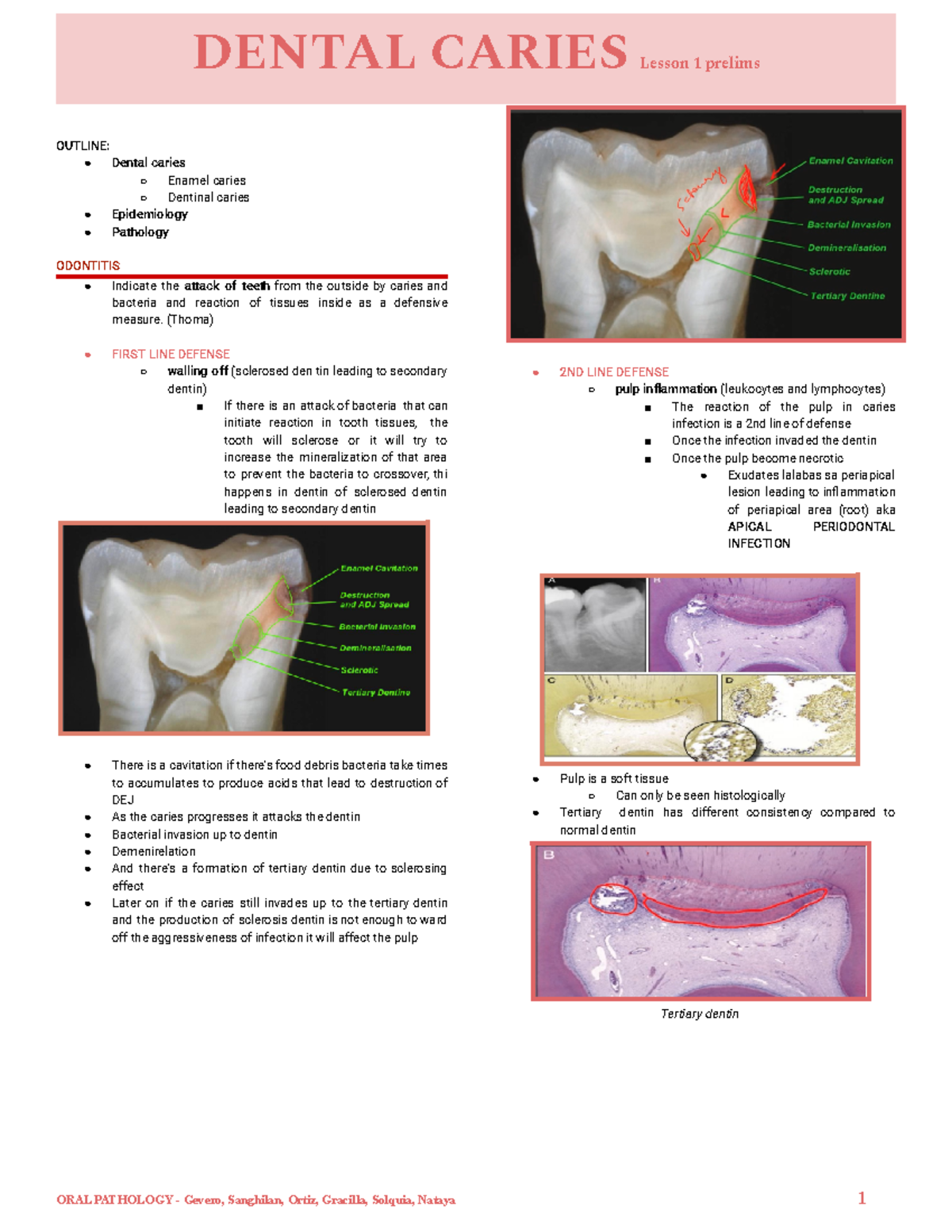 P1. Dental Caries - DENTAL CARIES Lesson 1 prelims OUTLINE: Dental ...