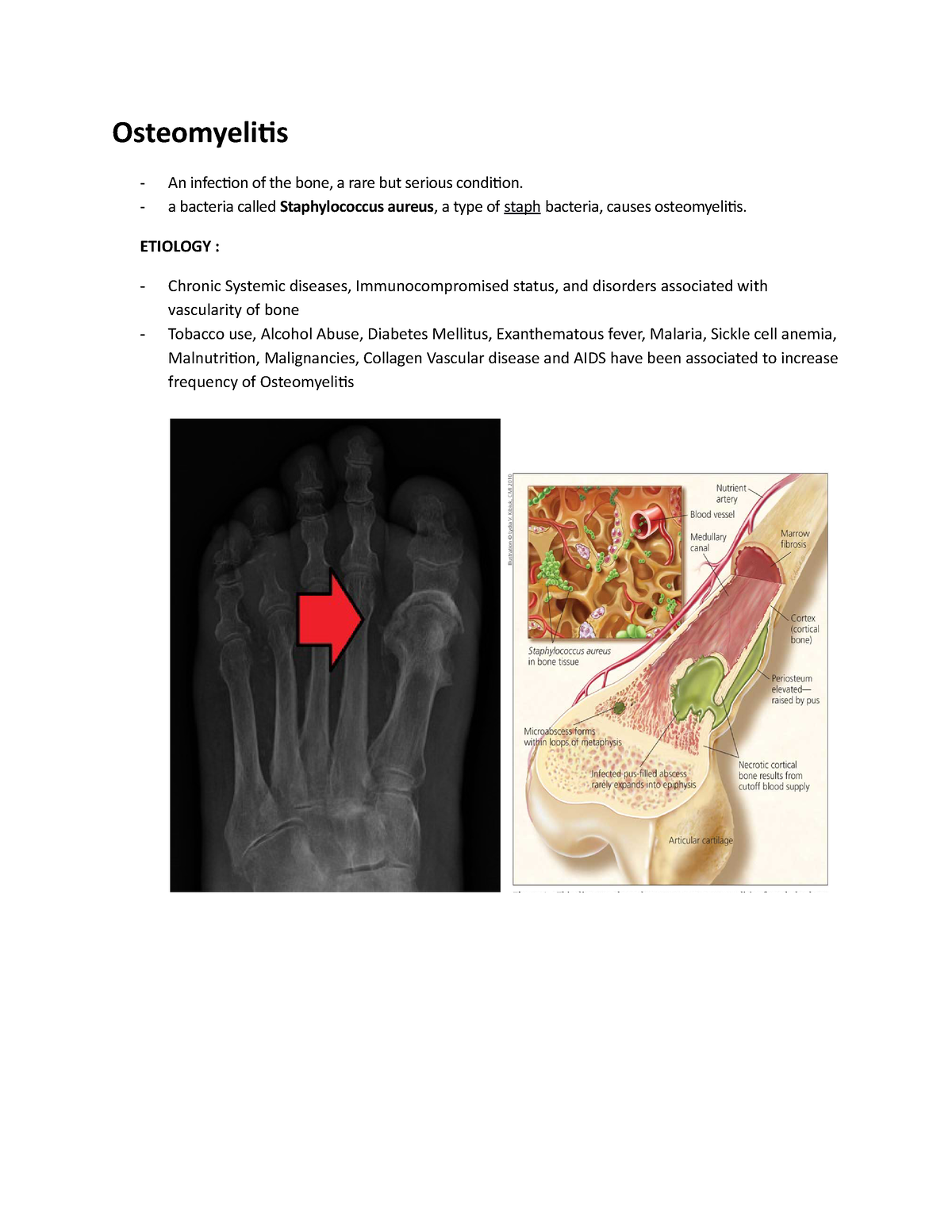 Osteomyelitis Notes - Osteomyelitis An Infection Of The Bone, A Rare ...