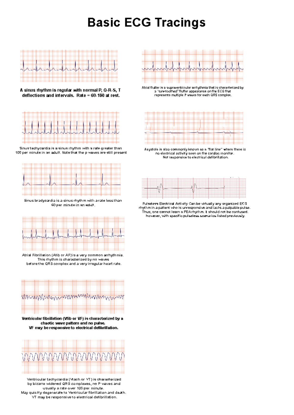 Basic-ECG - Ecg - BasicECG Tracings Asinusrhythm isregularwithnormalP,Q ...