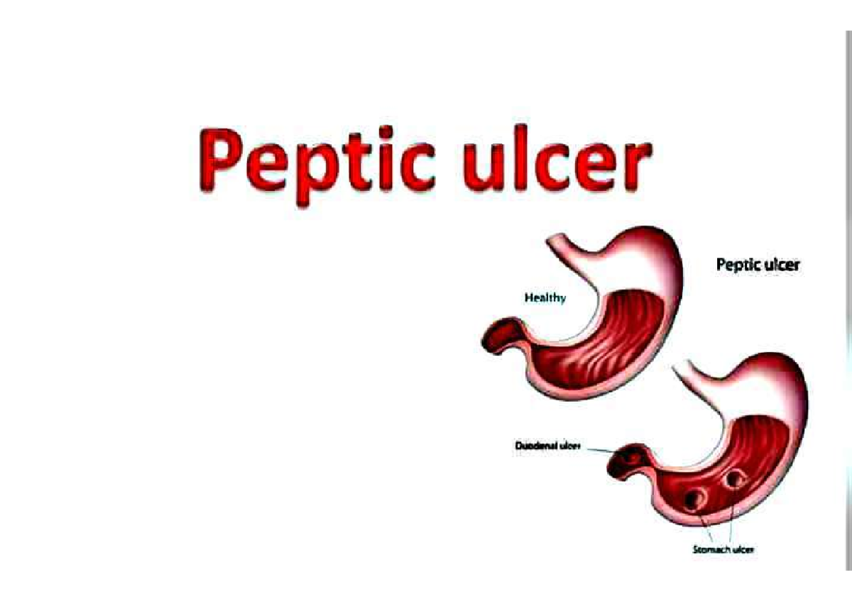 Peptic Ulcers complete slide Health and physical education Studocu