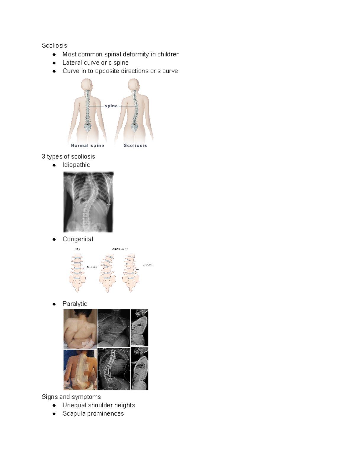 Scoliosis and MD - Scoliosis Most common spinal deformity in children ...