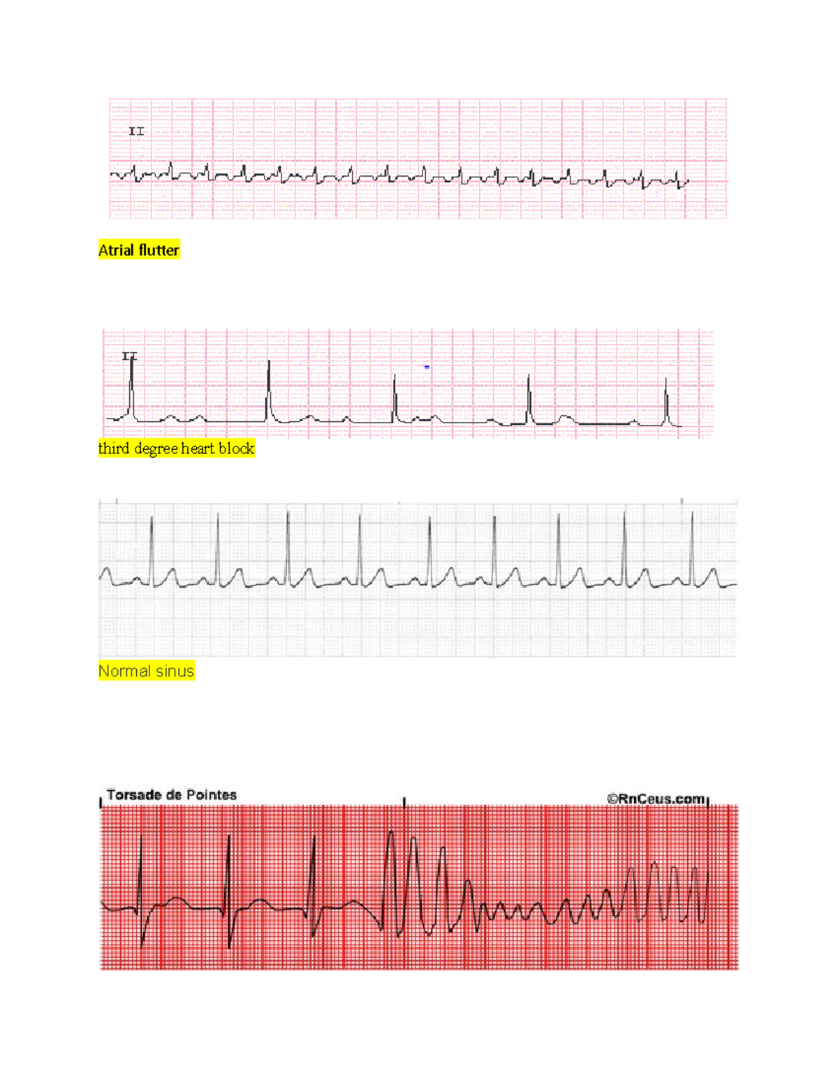 Ekg rhythms - Studocu