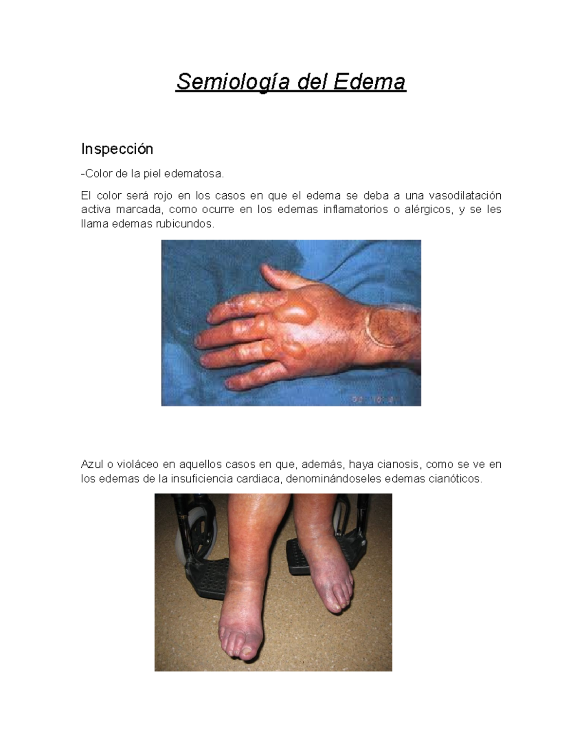 Semiologia de edema aplicado en inspeccion y palpacion, signos y ...