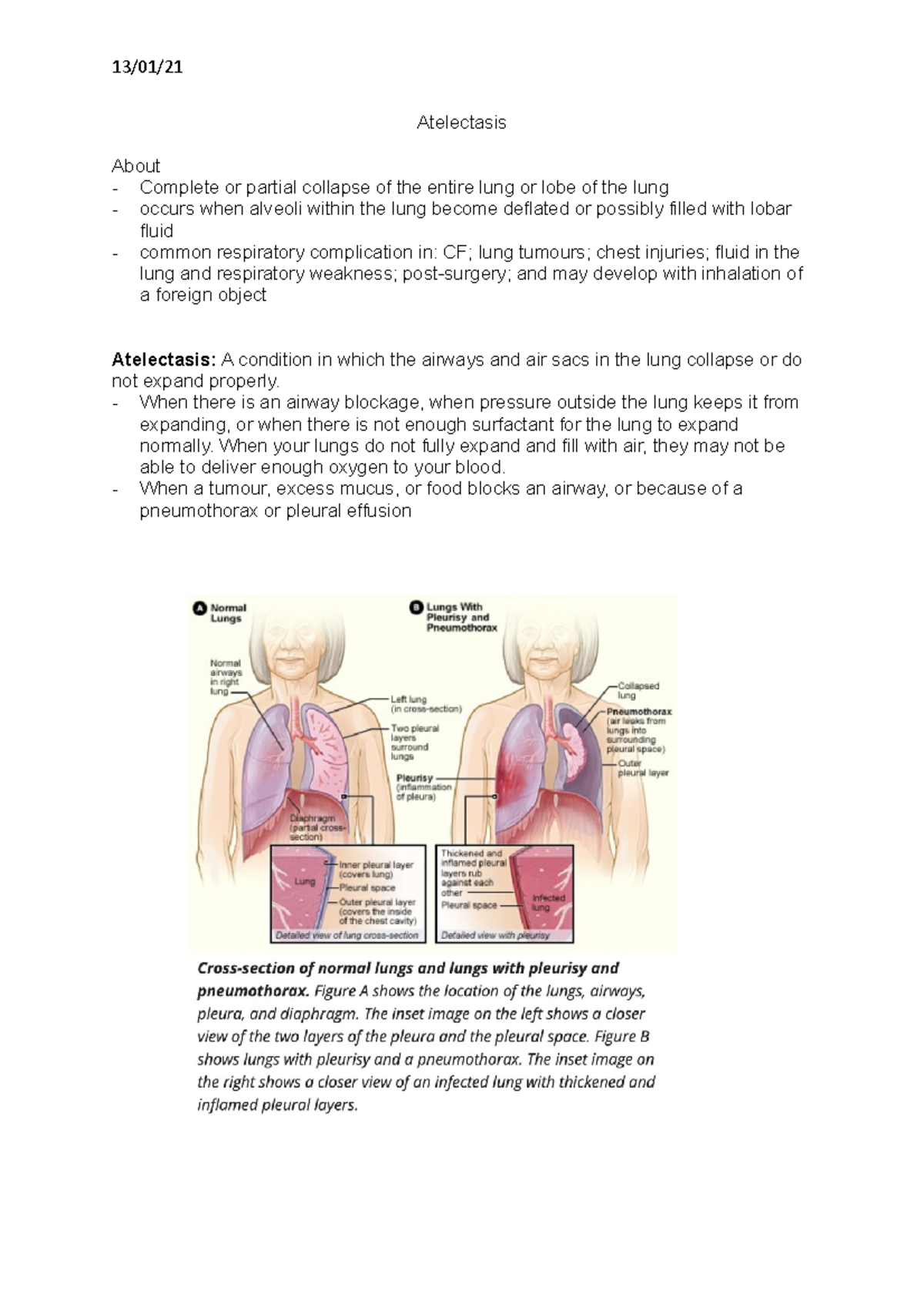 Atelectasis - 13/01/ Atelectasis About - Complete or partial collapse ...