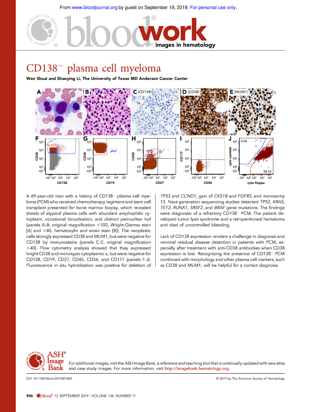 906 - work images in hematology CD 2 plasma cell myeloma Wen Shuai and ...