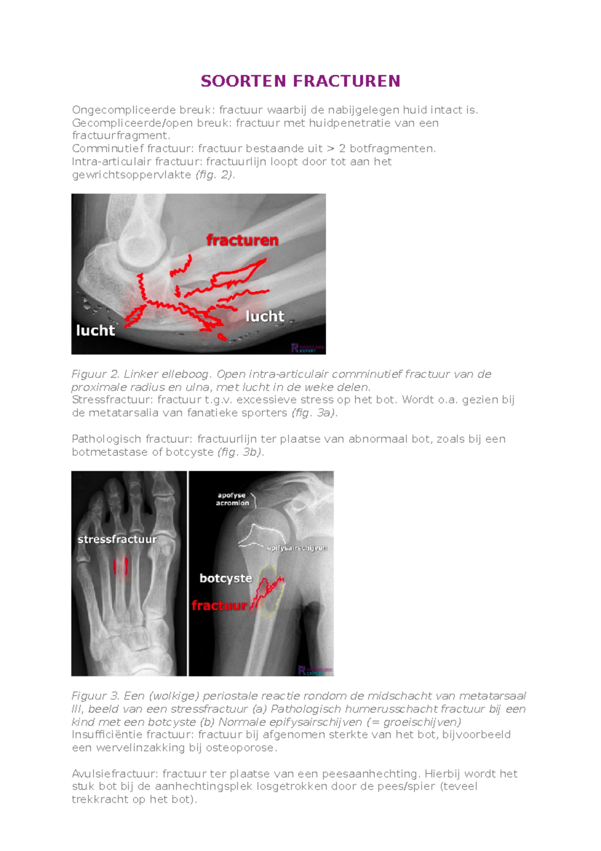 Soorten fracturen overzicht - SOORTEN FRACTUREN Ongecompliceerde breuk ...