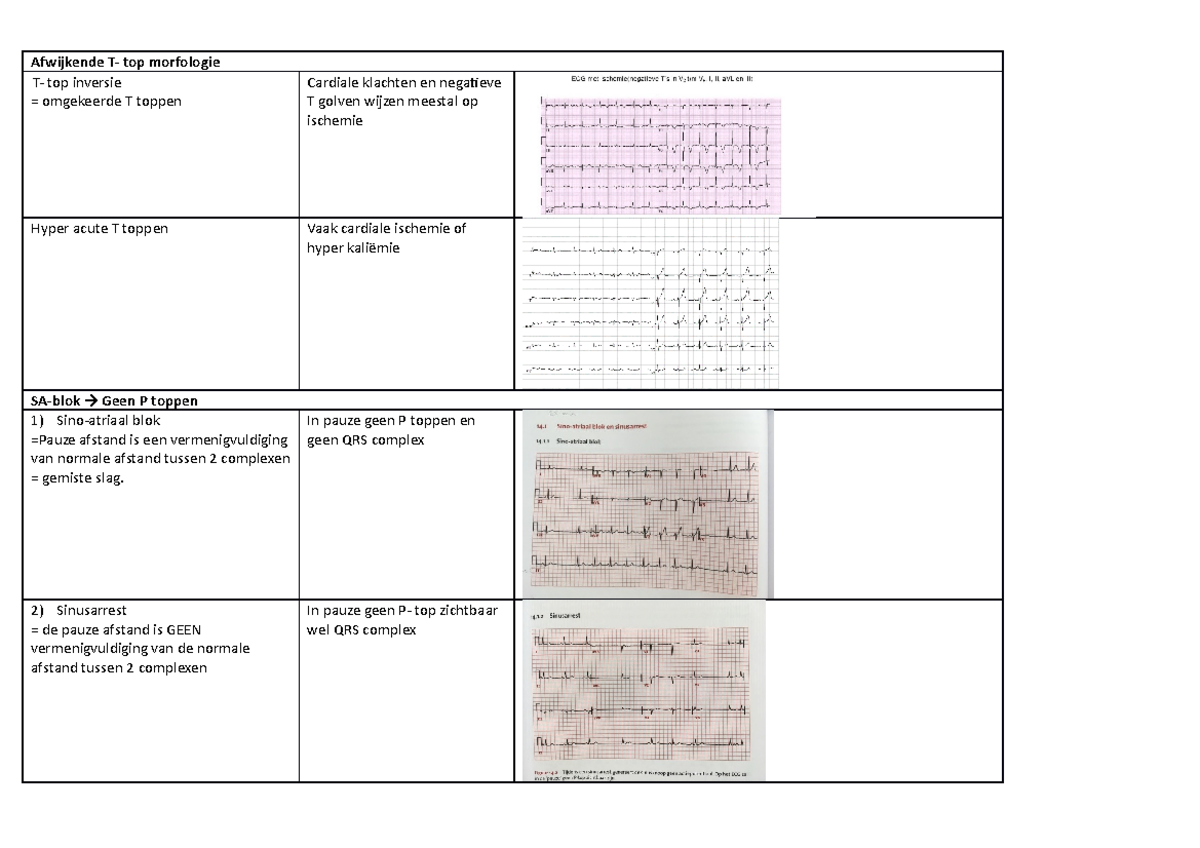 Samenvatting van alle ECG's - Afwijkende T- top morfologie T- top