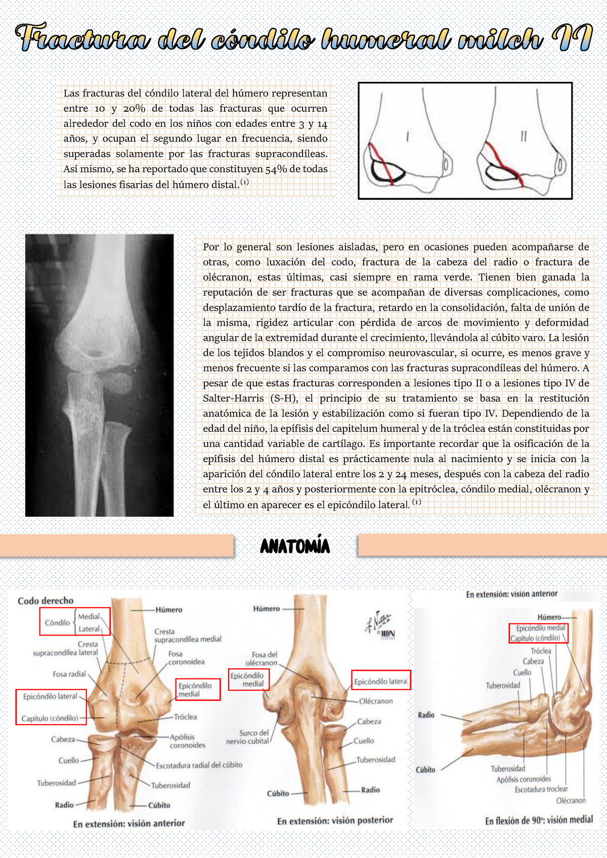 Fractura de codo en pediatria Las fracturas del cóndilo lateral del