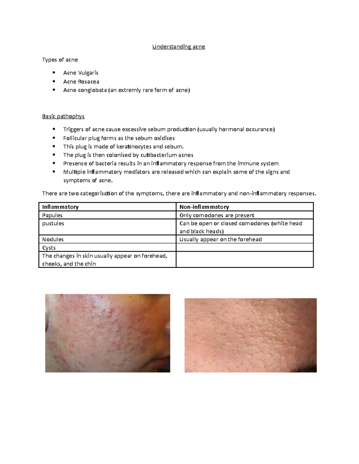 Understanding acne essay picture