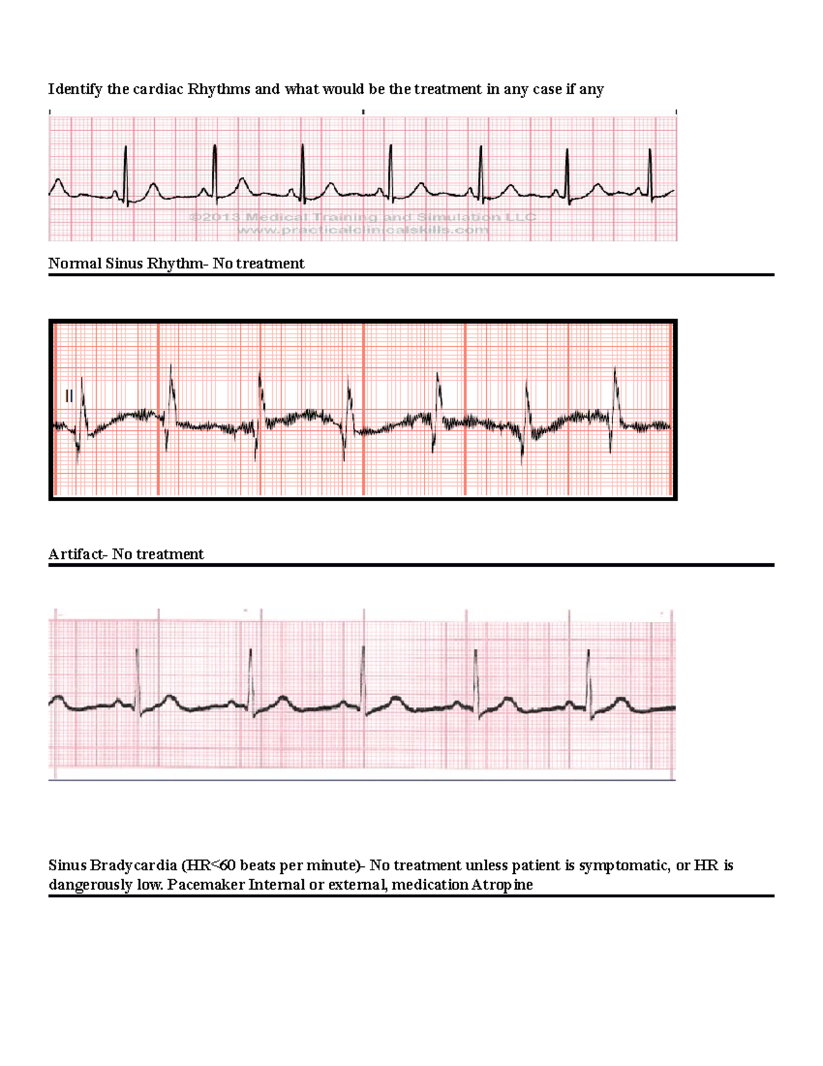 Cardiac Rhythms - Pacemaker Internal or external, medication Atropine ...