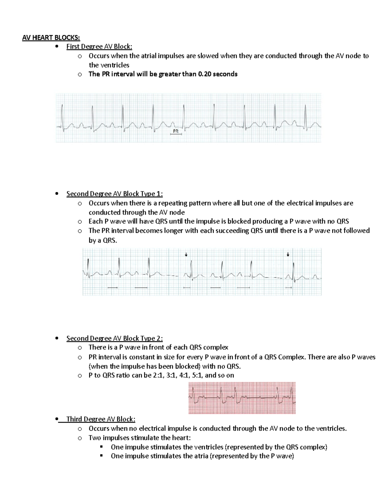 Module 1 Blueprint - AV HEART BLOCKS: First Degree AV Block: o Occurs ...