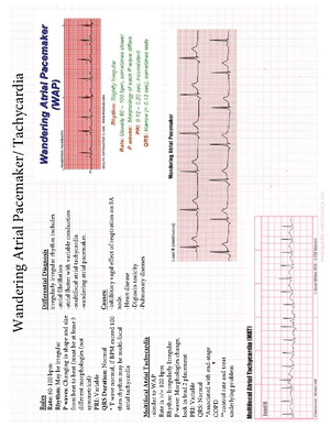 PVC - EKG information - ... Premature Ventricular Complex (PVC) A ...