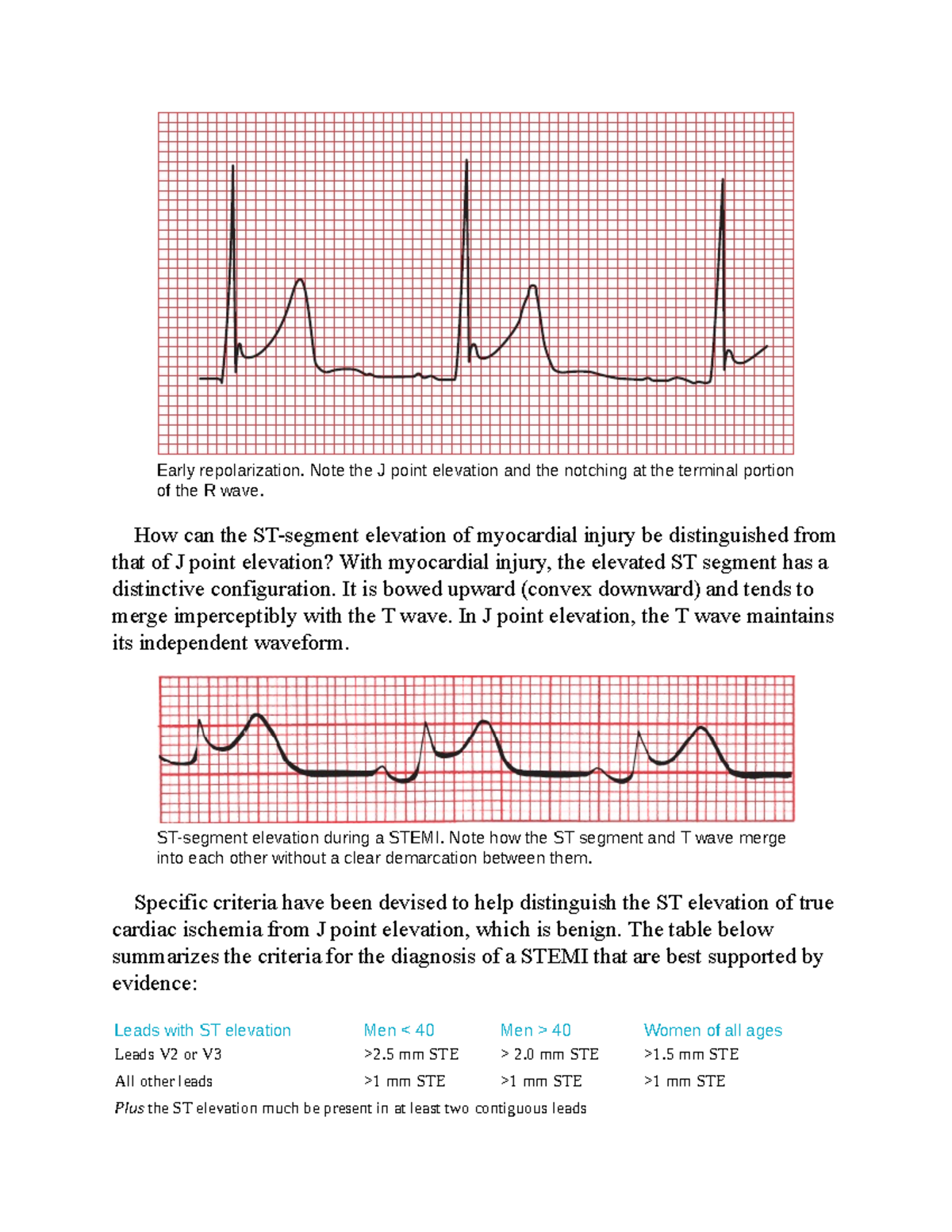 The only EKG-85 - The only EKG - Early repolarization. Note the J point ...