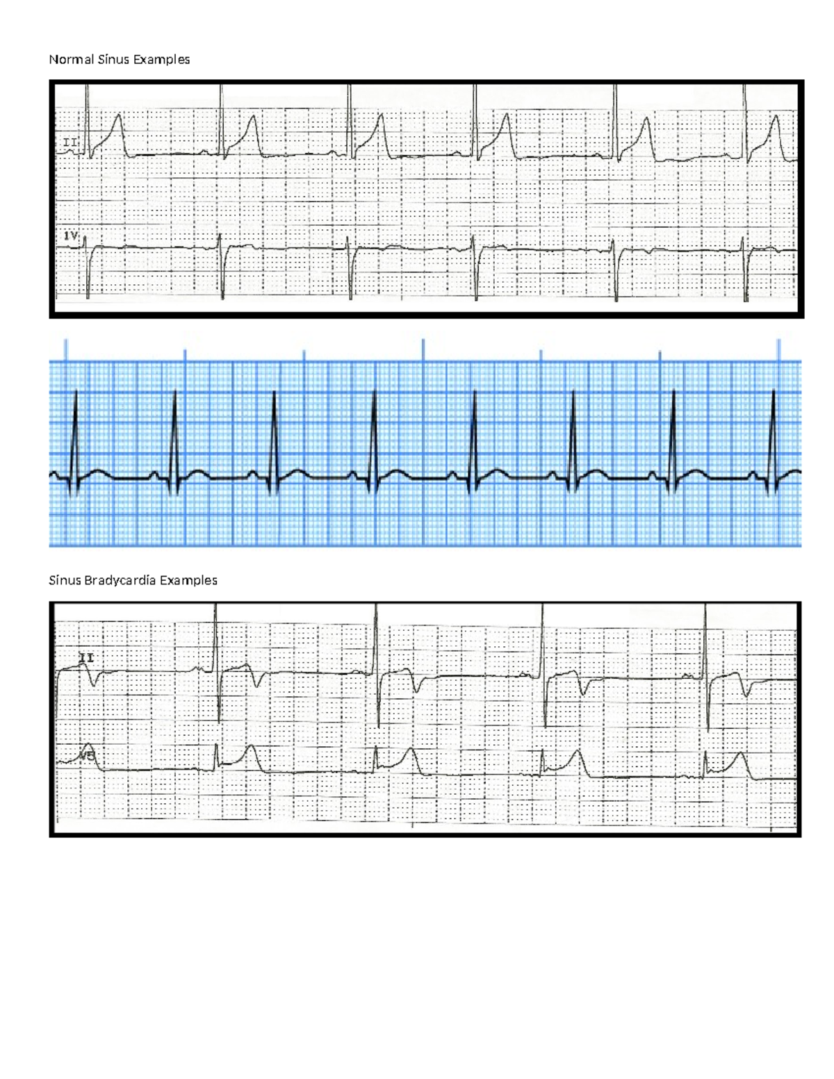 EKG+examples-1 - NS 125 - Normal Sinus Examples Sinus Bradycardia ...