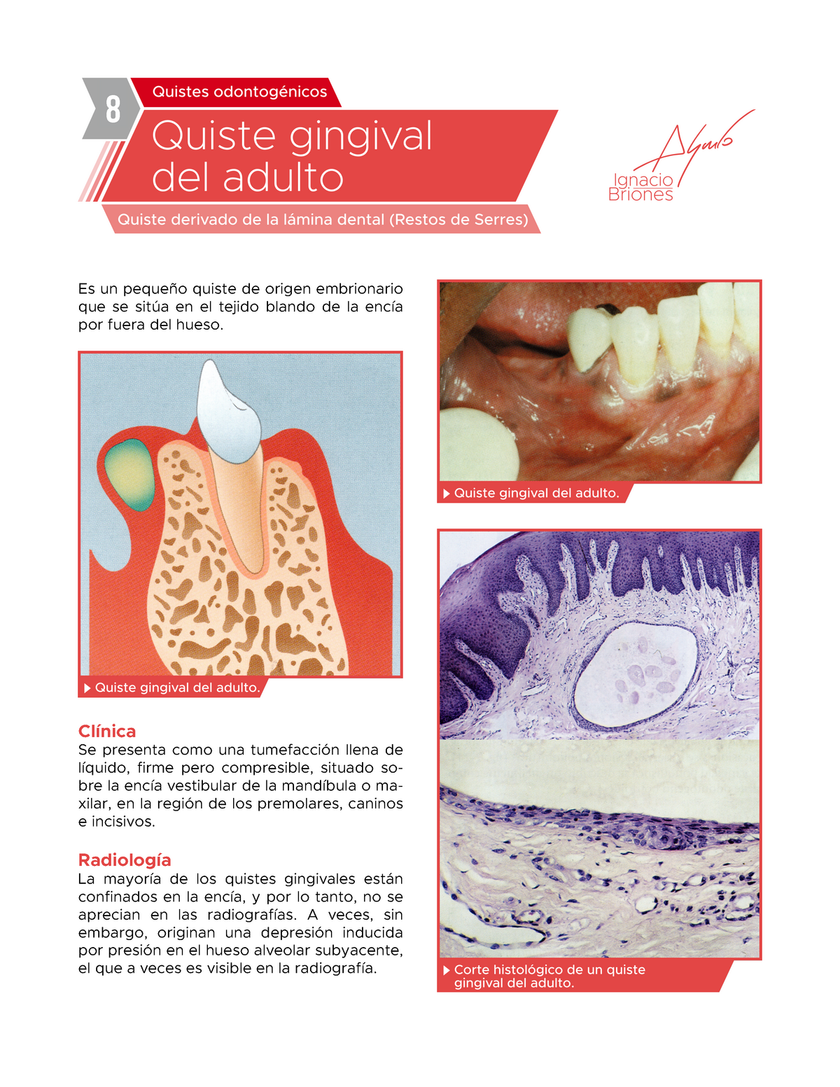 Quiste Gingival del Adulto Patología oral e histología