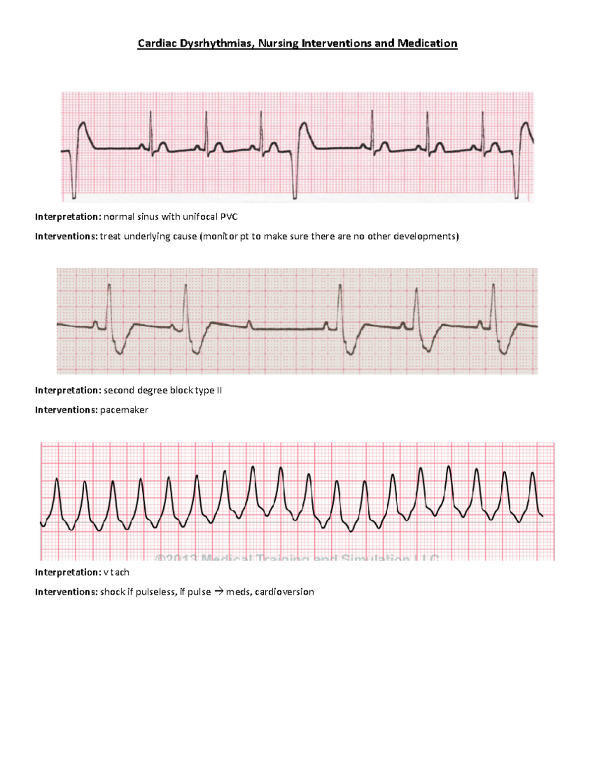 19. Ekg Practice - Lecture Notes - Cardiac Dysrhythmias, Nursing 