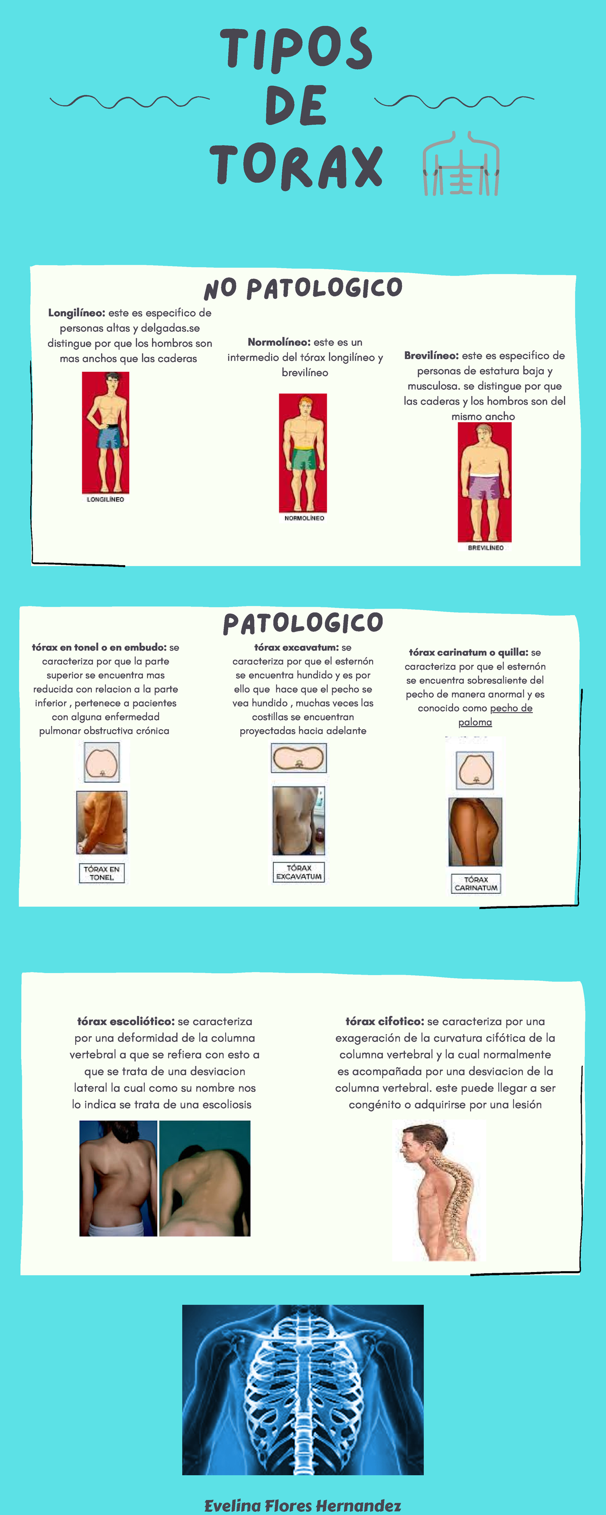 Tipos De Torax Ejemplos Tipos De Torax Longil Neo Este Es Especifico De Personas Altas Y