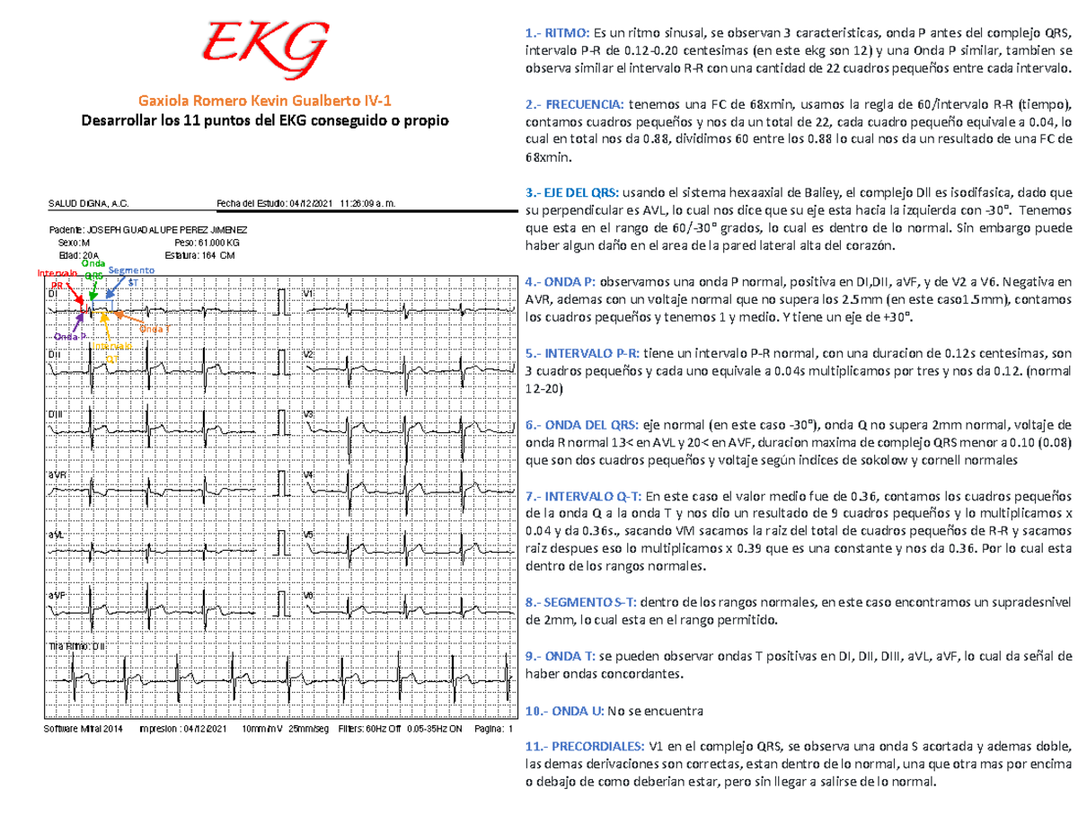 EKG - Descripción De Electrocardiograma Con Sus 11 Puntos - SALUD DIGNA ...