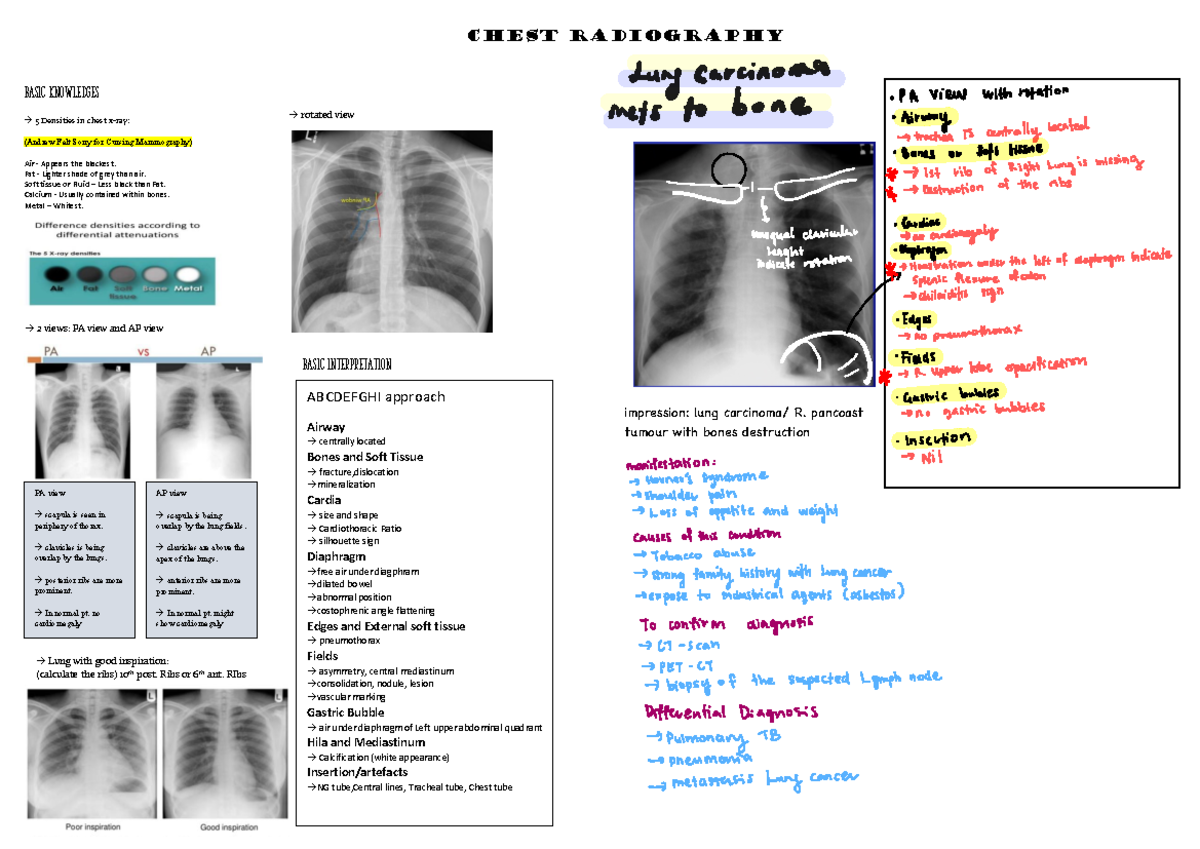 Summary of abnormal Radiology of chest x ray - Chest Radiography Basic ...