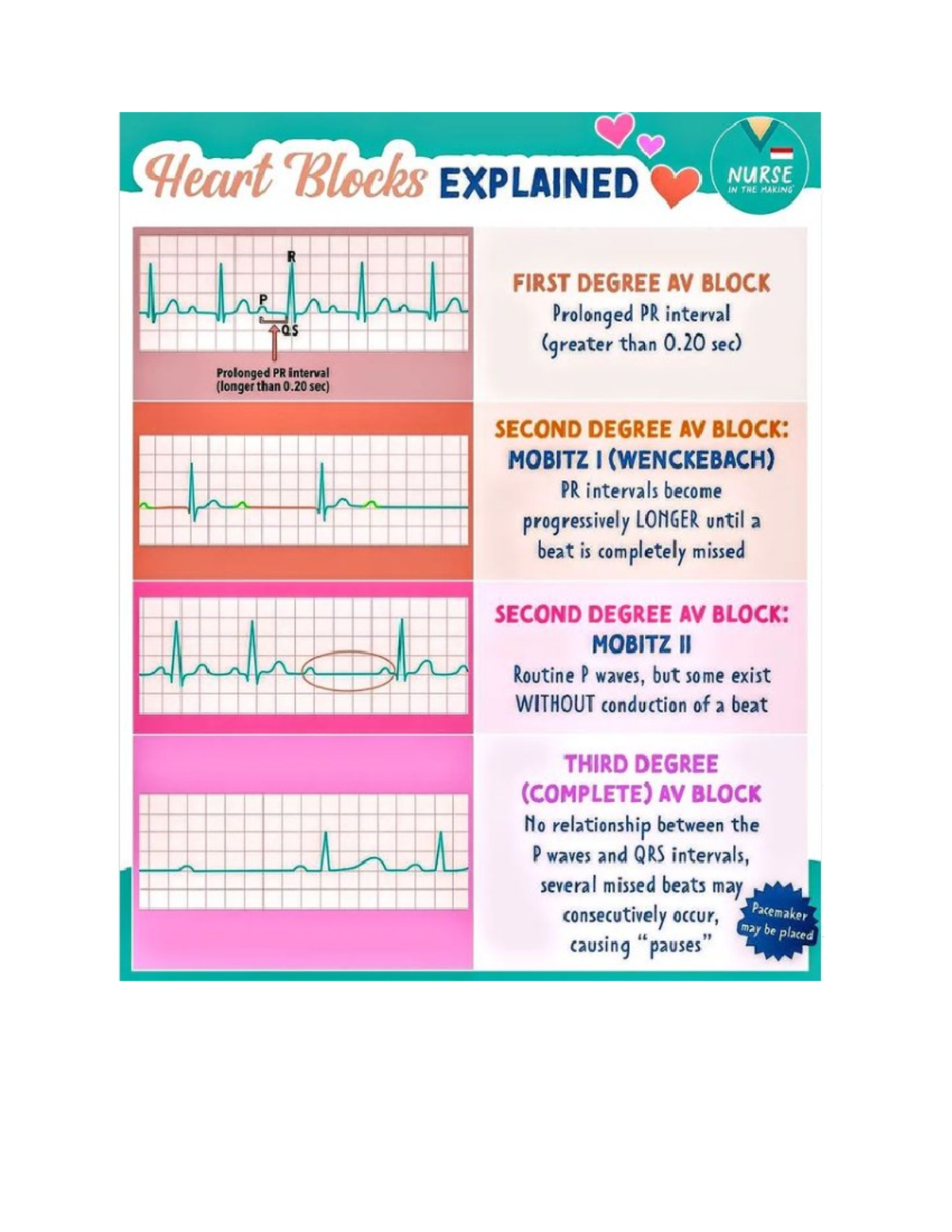 heart block patho - Heart Blocks EXPLAINED NURSE IN THE MAKING R FIRST ...