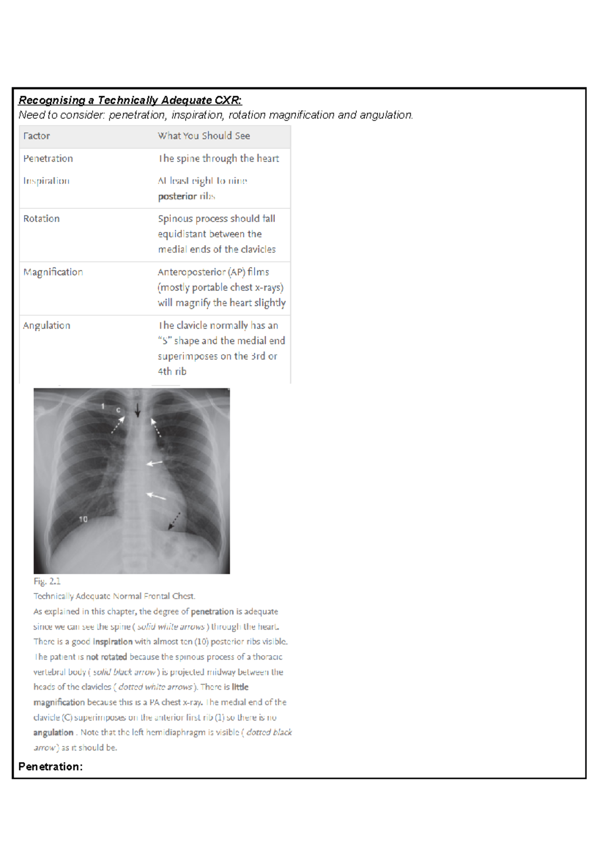 Chest X-ray - Lecture notes Year 4 Respiratory - Recognising a ...