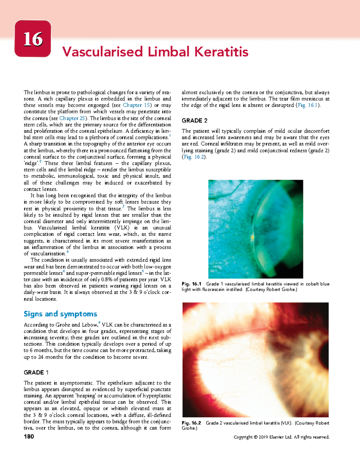 Vascularised Limbal Keratitis Contact Lens Complications 1616