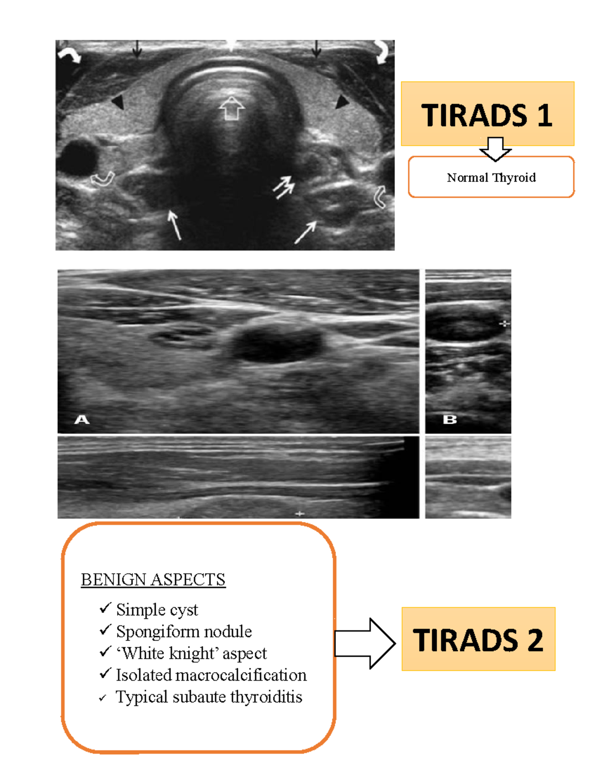 Tirads - TIRADS 1 Normal Thyroid BENIGN ASPECTS Simple cyst Spongiform ...