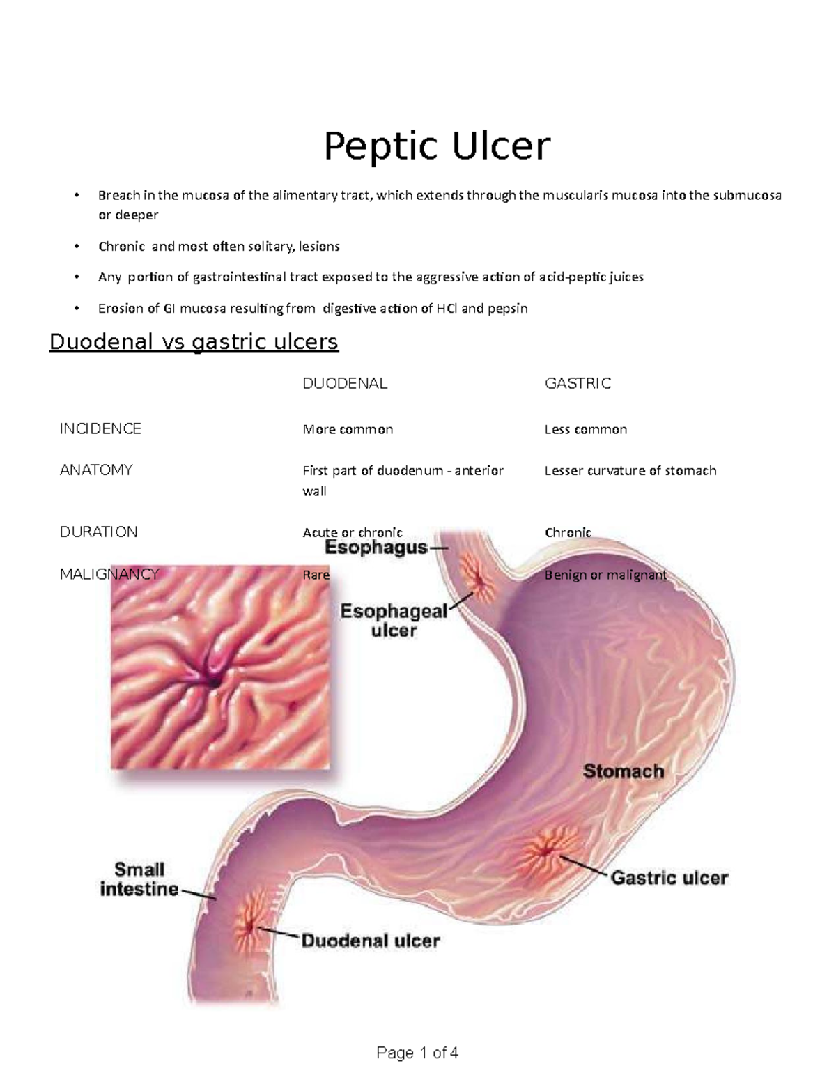 Chapter - 30 Peptic ulcer - Peptic Ulcer Breach in the mucosa of the ...