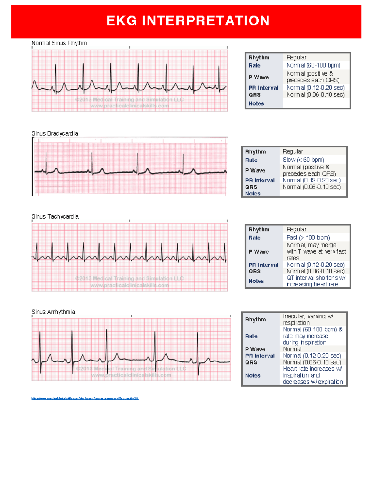 EKG Interpretations - EKG INTERPRETATION Normal Sinus Rhythm Sinus ...