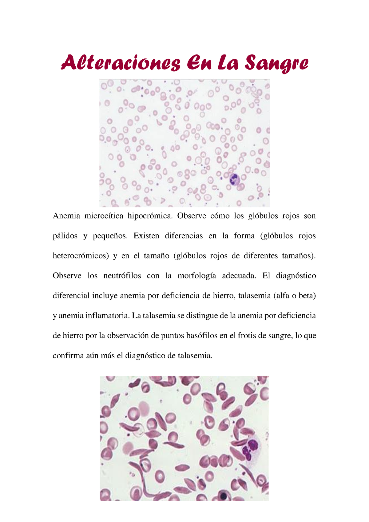 Alteraciones En La Sangre Alteraciones En La Sangre Anemia Microcítica Hipocrómica Observe 