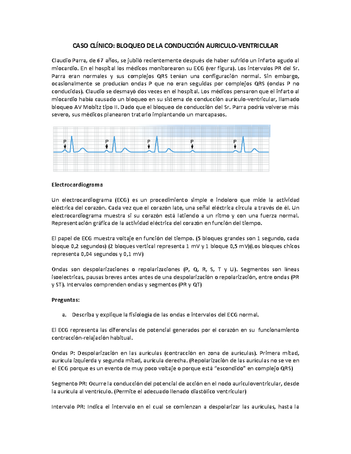 Bloqueo DE LA Conduccion Auriculo- Ventricular - CASO CLÍNICO: BLOQUEO ...