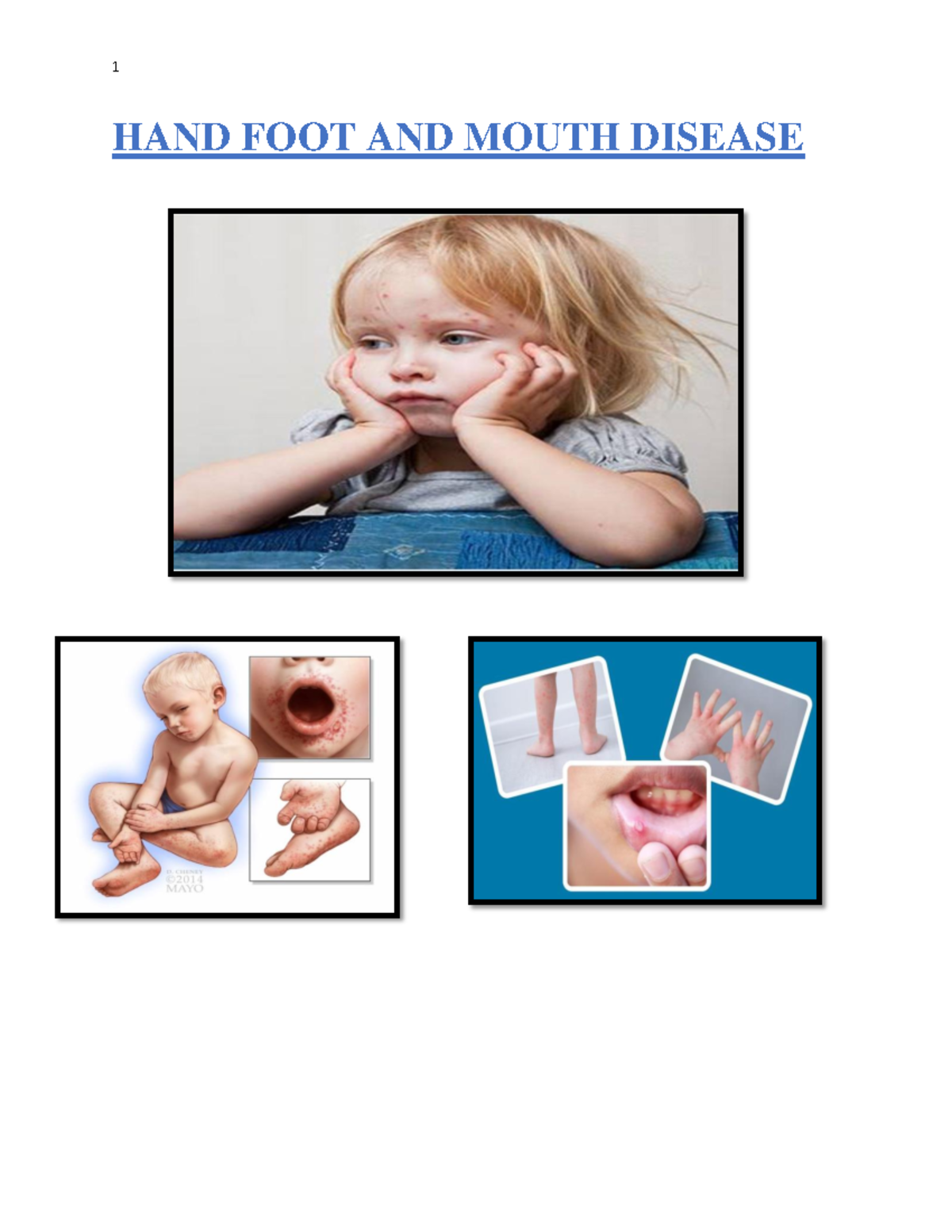 hand-foot-and-mouth-disease-hand-foot-and-mouth-disease-health-is