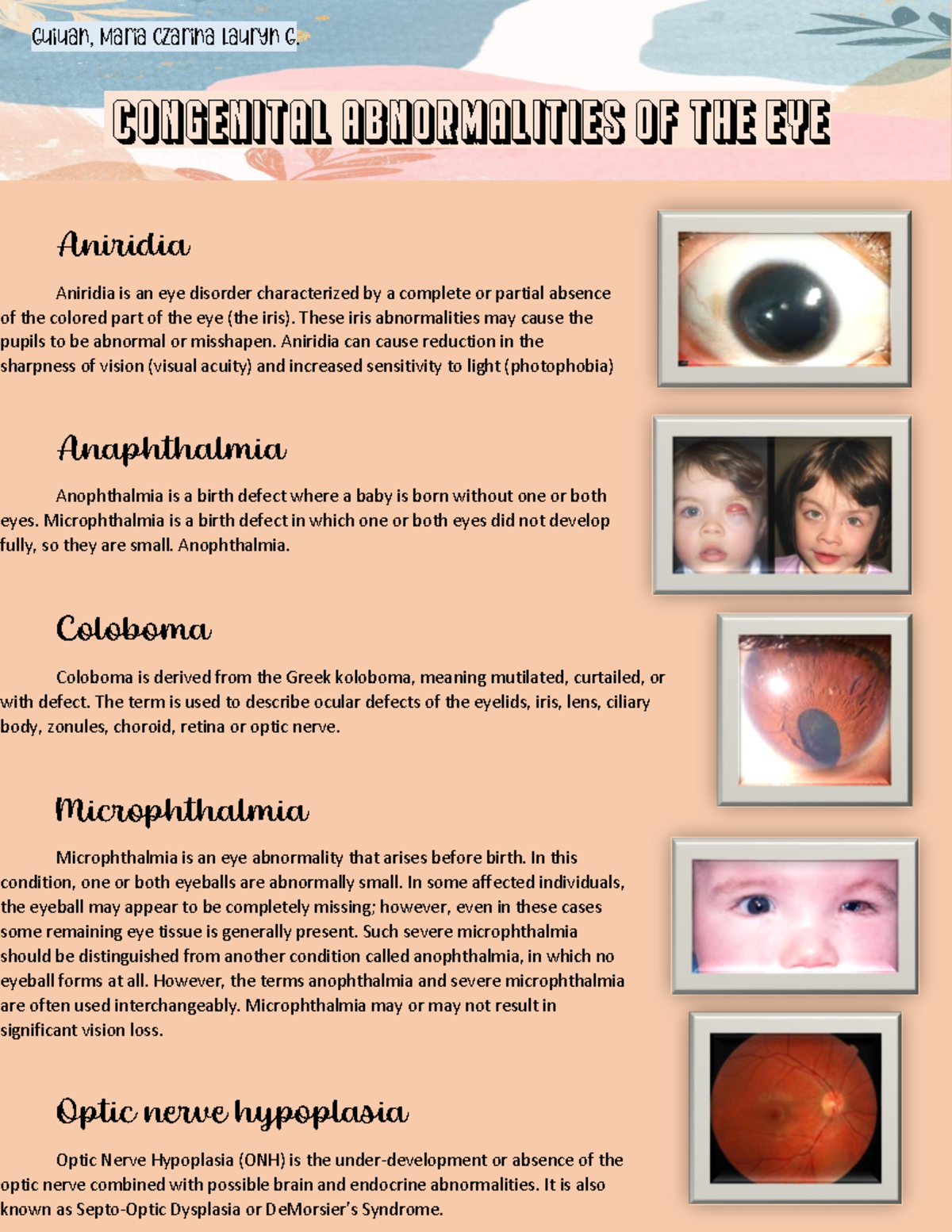 Congenital Abnormalities Aniridia Aniridia is an eye disorder