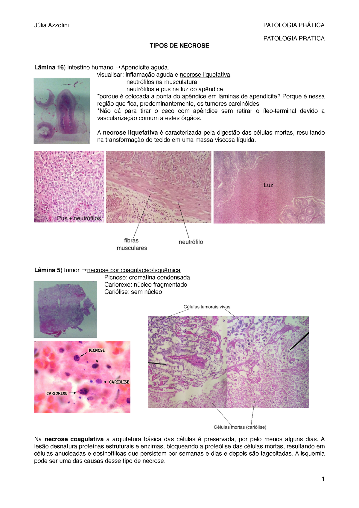 Patologia Pr Tica Resumo Patologia Pr Tica Tipos De Necrose L Mina Intestino Humano