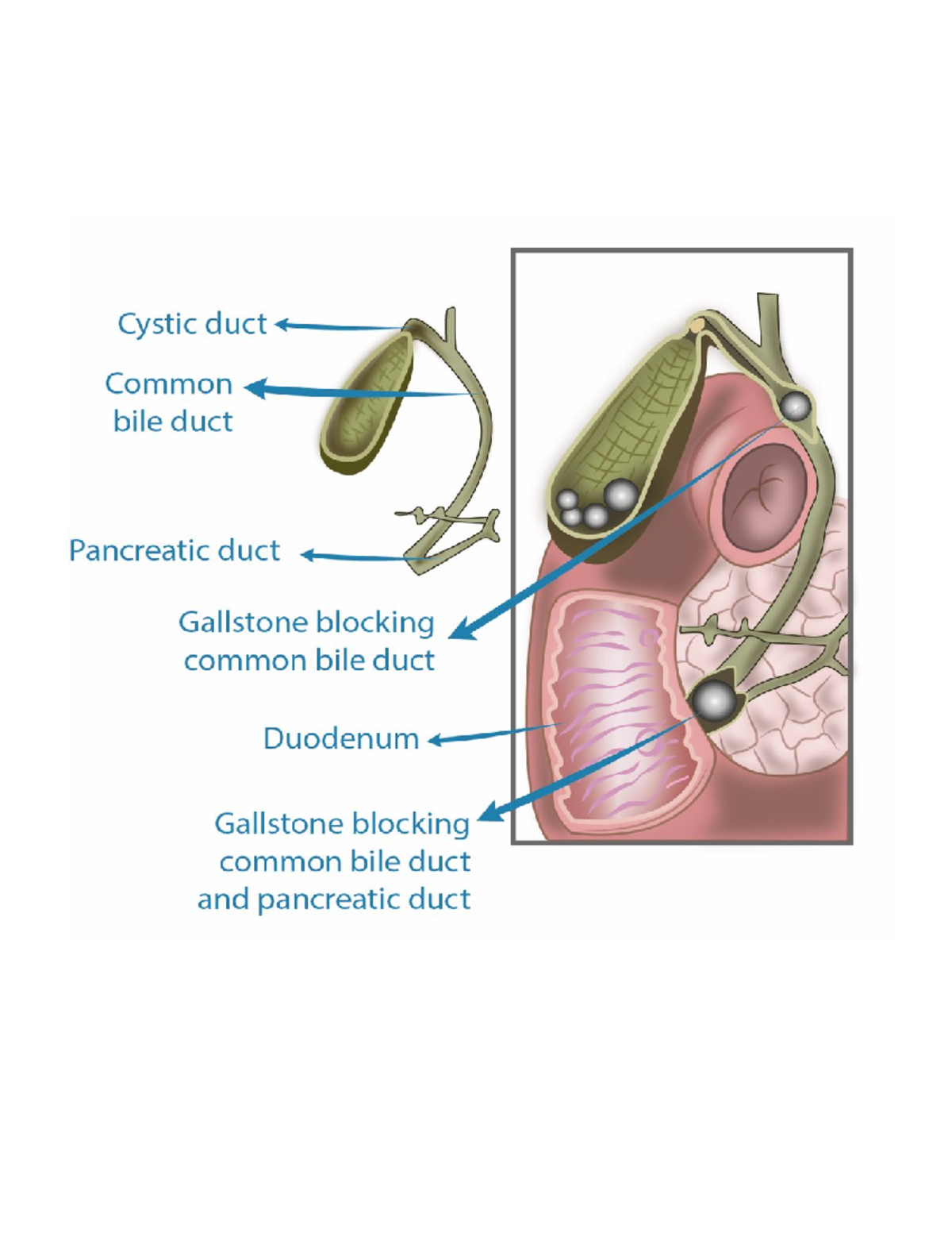 GIT surgery CBD Stones - Common Bile Duct Stones ( Choledocholithiasis ...