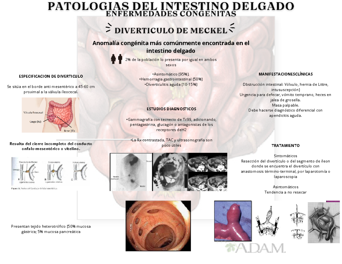 Diverticulo De Meckel Resumen Cirugía General Anomalía Congénita