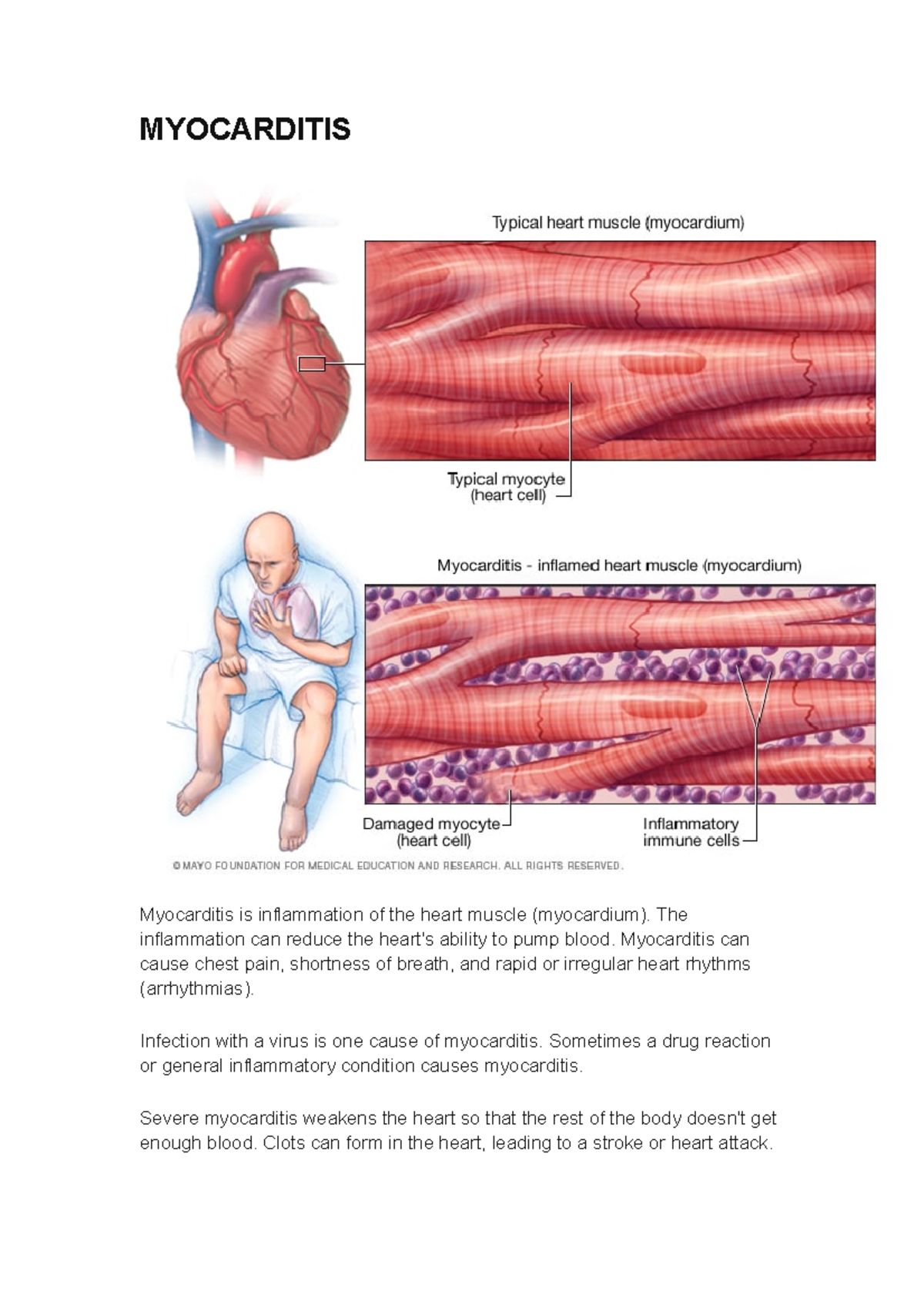 Myocarditis - MYOCARDITIS Myocarditis Is Inflammation Of The Heart ...