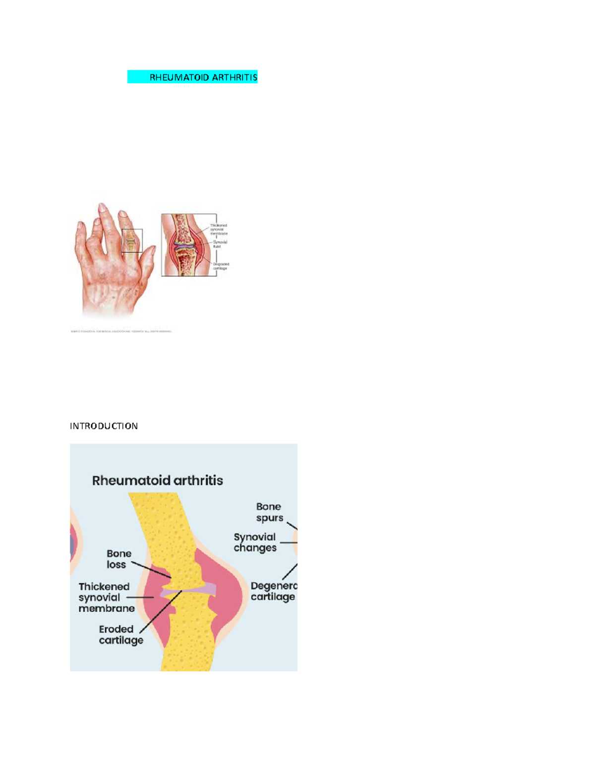 Rheumatoid Arth-wps Office - Rheumatoid Arthritis Introduction 