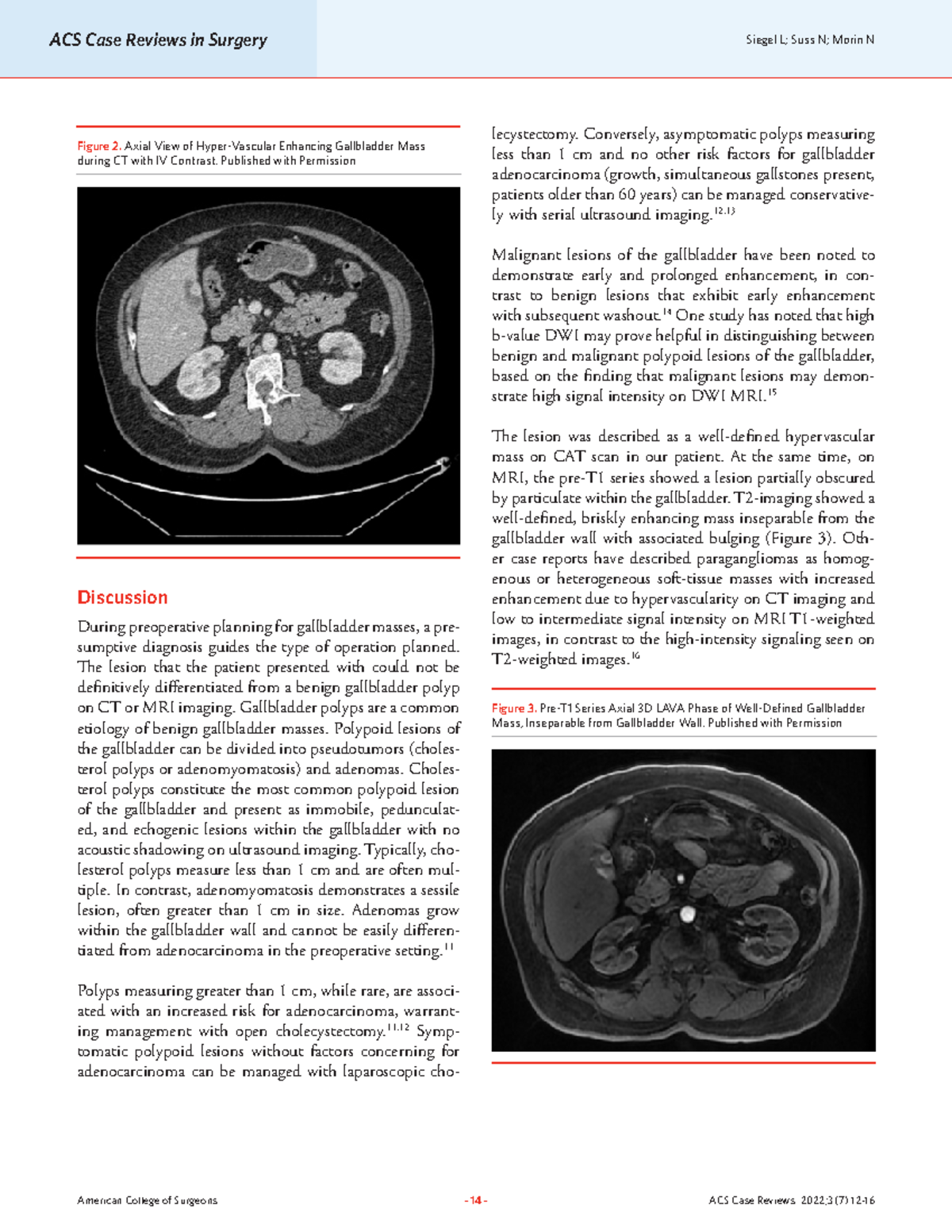 Siegel paraganglioma of gallbladde 2 ACS Case Reviews in Surgery