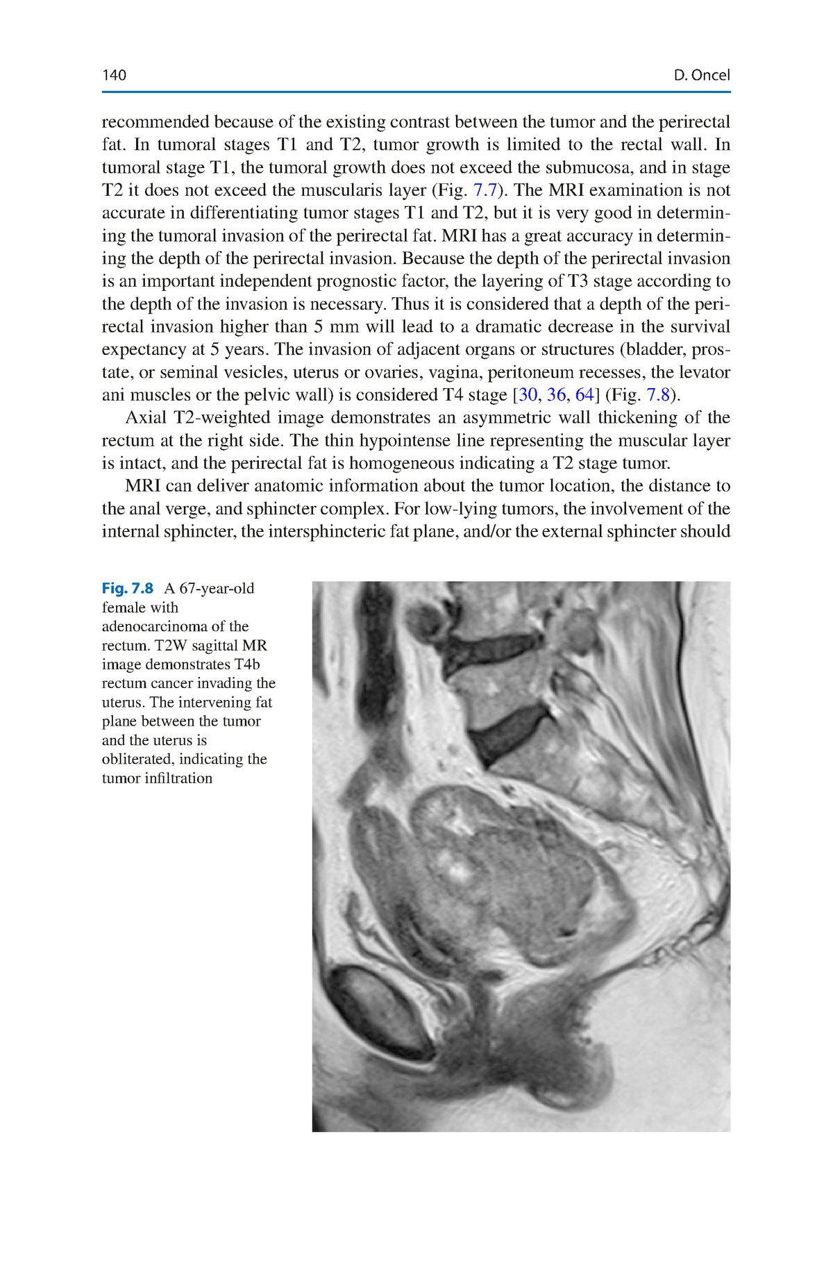 colon-polyps-and-colorectal-cancer-151-200-140-recommended-because-of