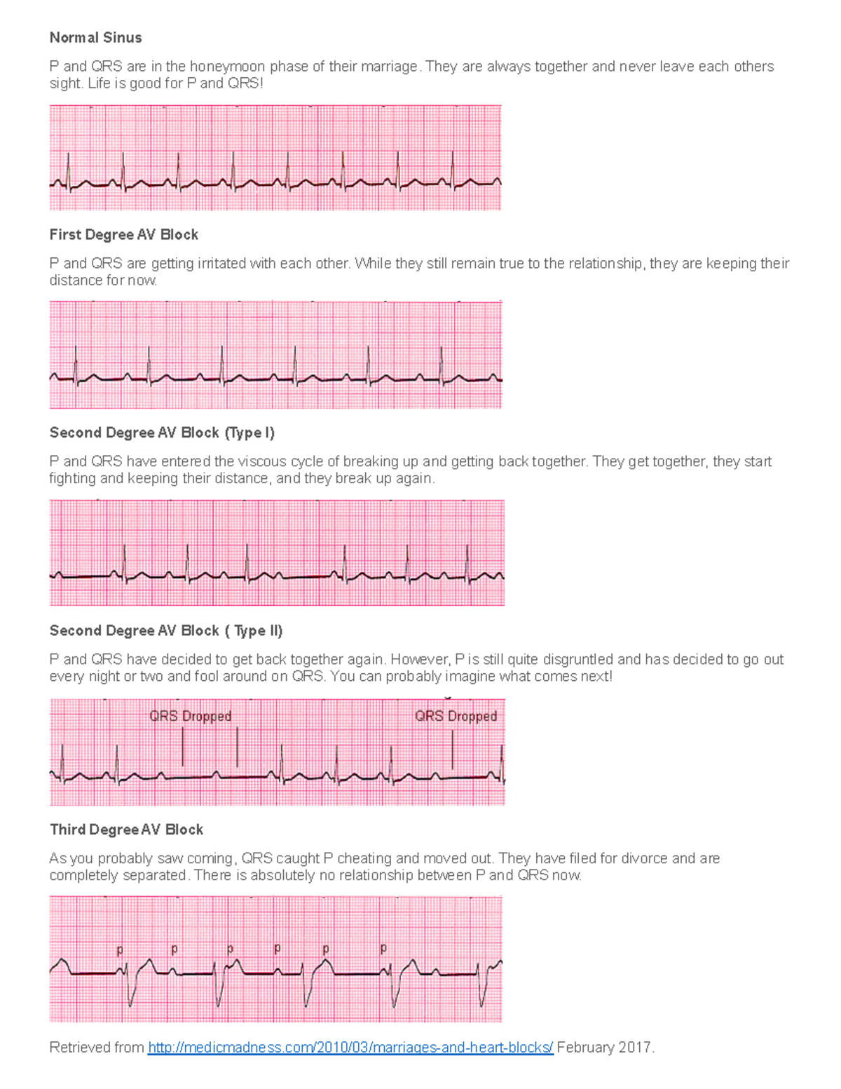 Heart Block Marriage Illustration - Normal Sinus P and QRS are in the ...