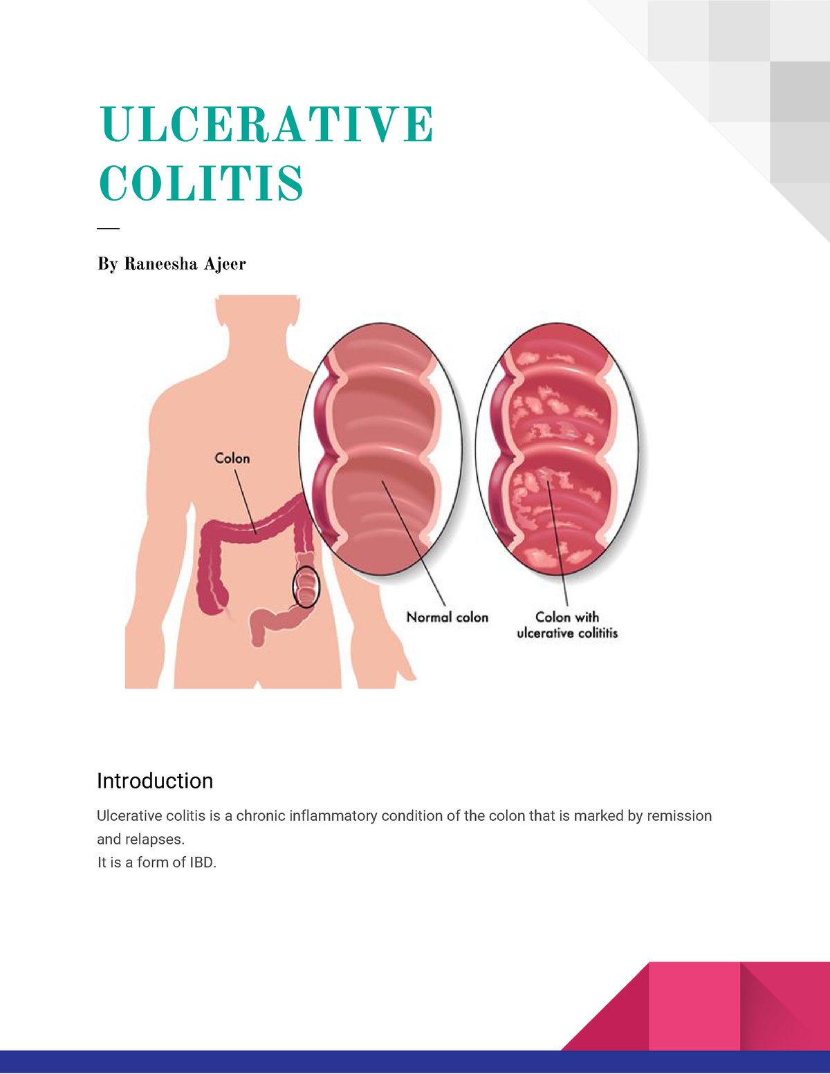 Ulcerative colitis is a chronic inflammatory condition of the