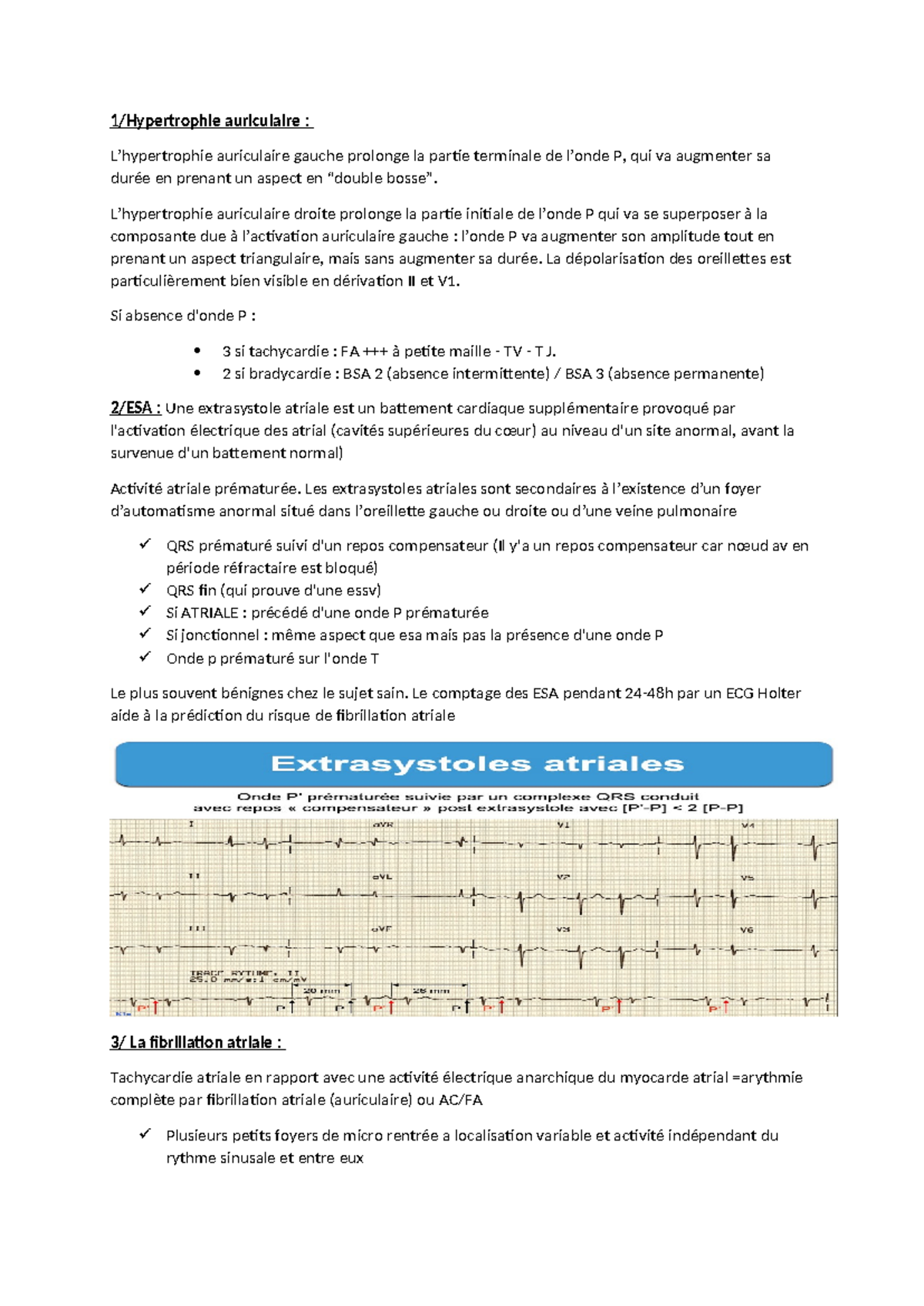 Ecg Pathologique Resumé 1hypertrophie Auriculaire Lhypertrophie Auriculaire Gauche 1605