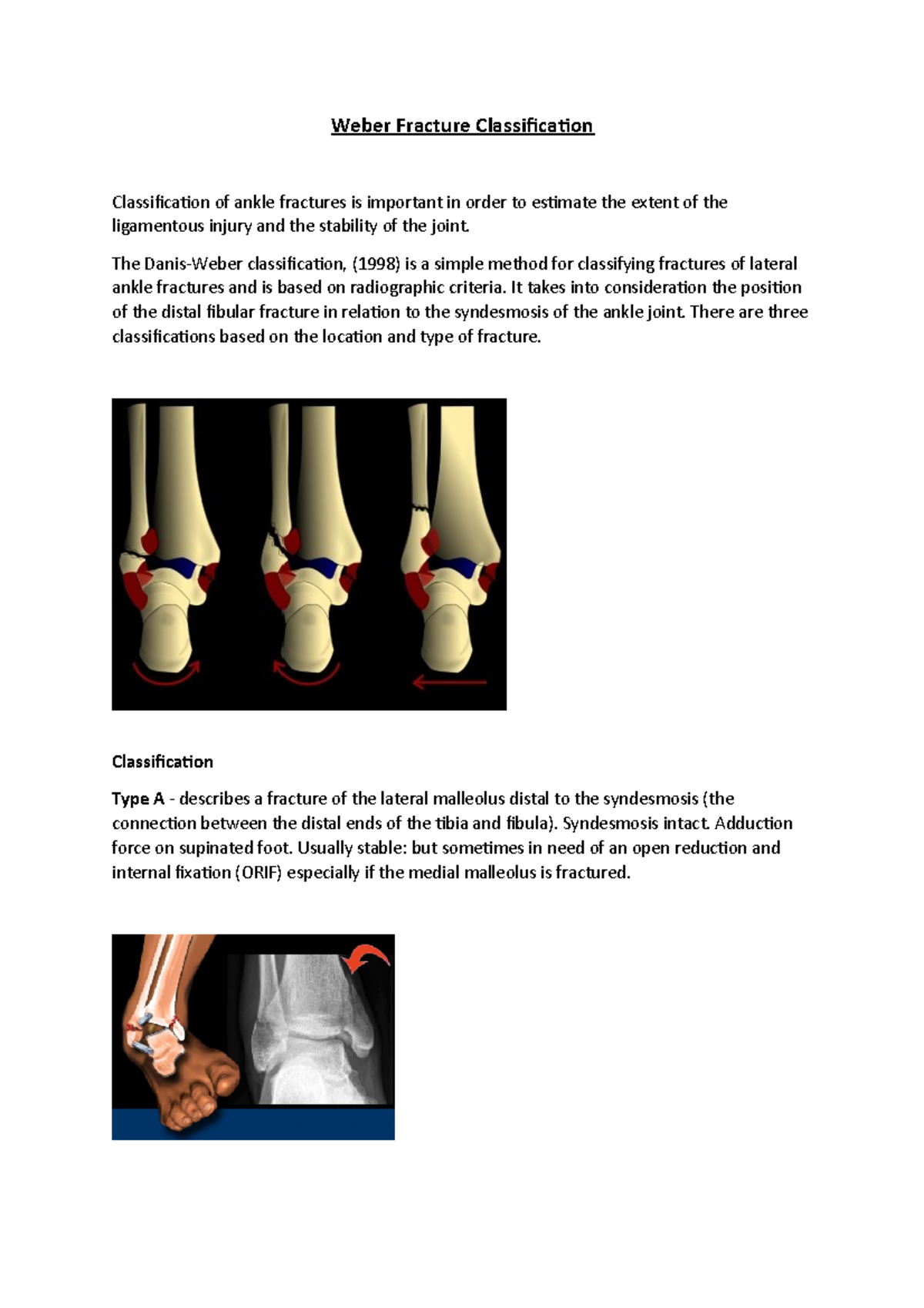 Weber fracture - The Danis-Weber classification, (1998) is a simple ...