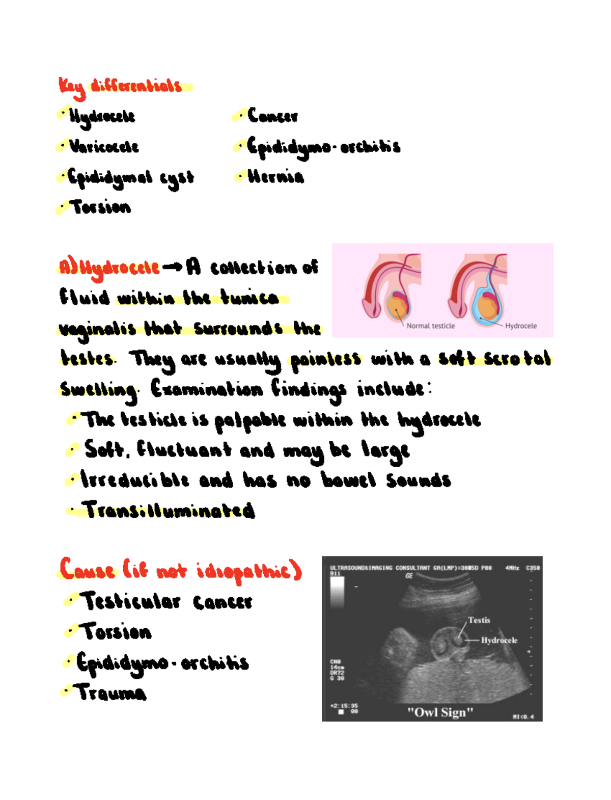 Scrotal Lumps Key Differentials Hydrocele Varicocele Epididymo